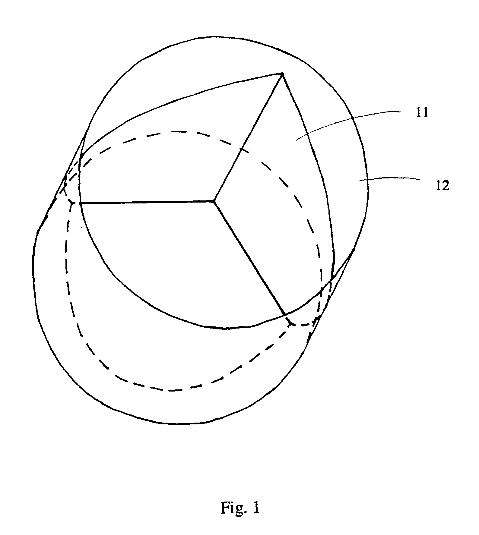 Venous valve and graft combination