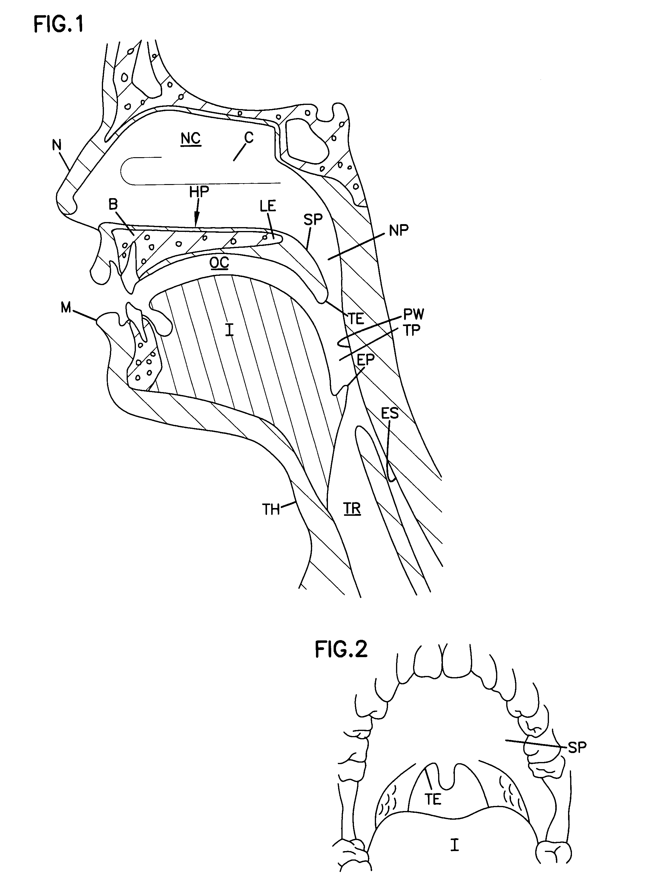 Airway implant cartridge and kit