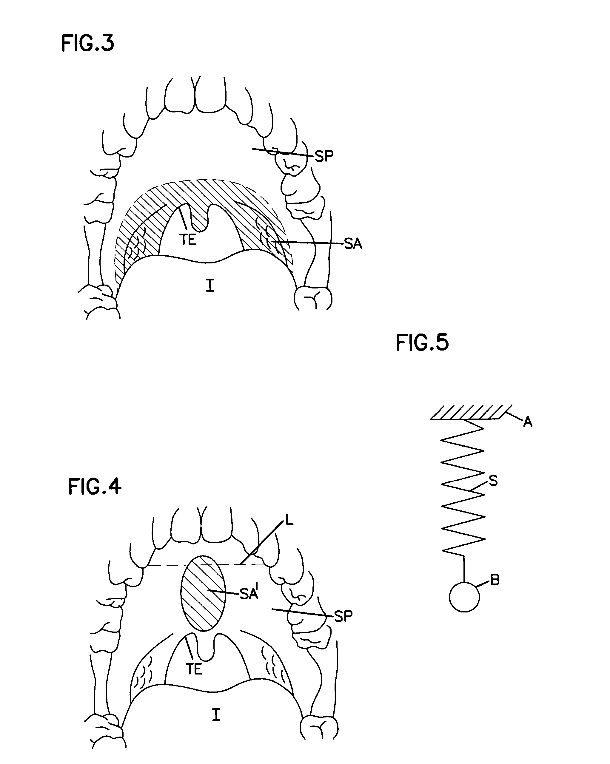 Airway implant cartridge and kit