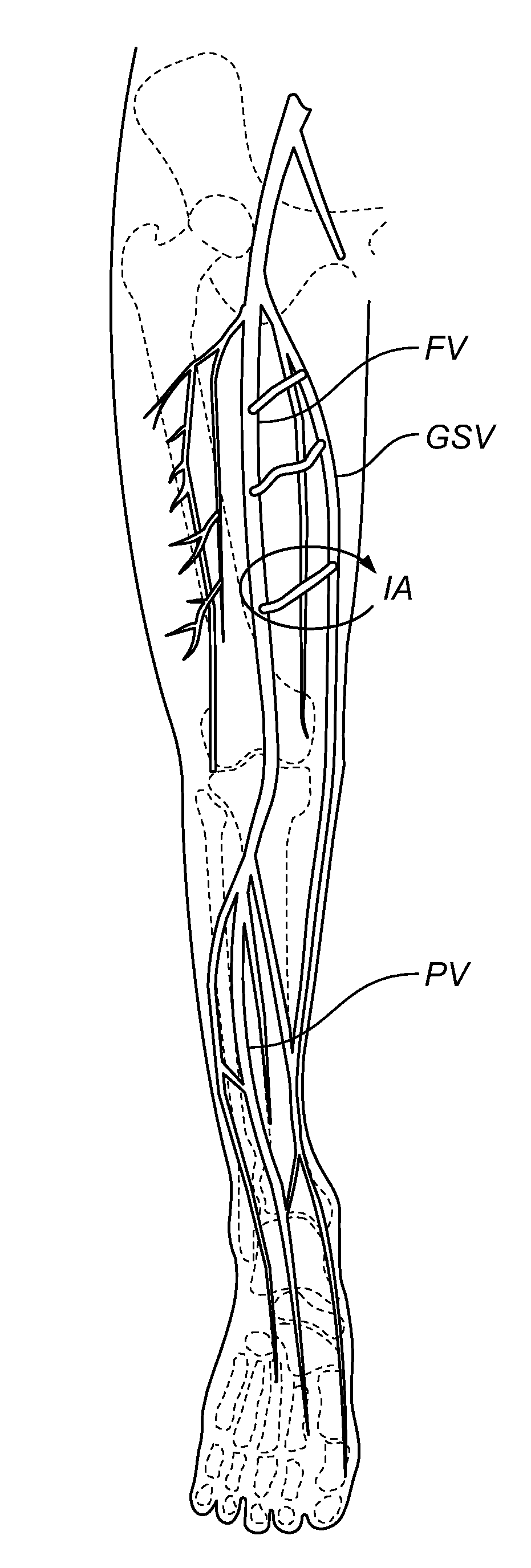 Methods, Devices and Systems for Treating Venous Insufficiency