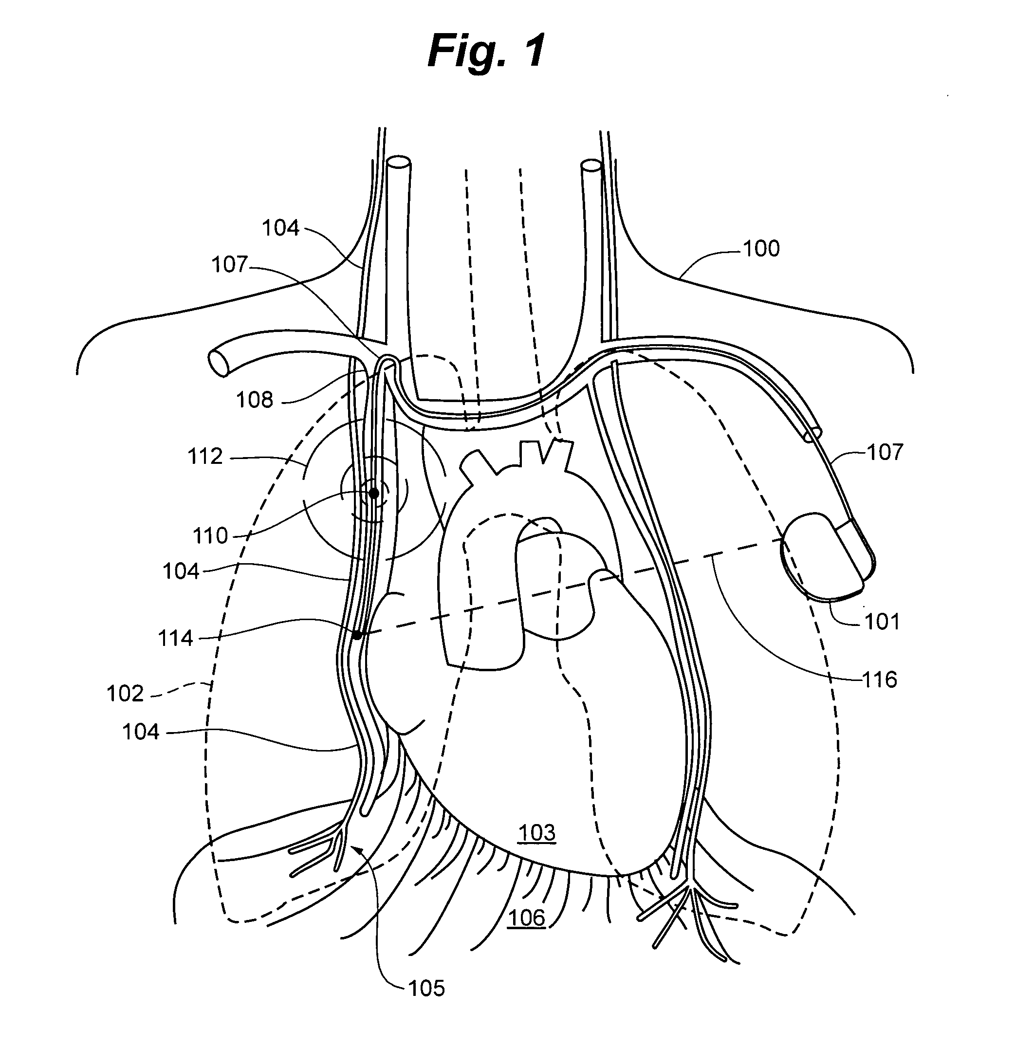 System and method to modulate phrenic nerve to prevent sleep apnea