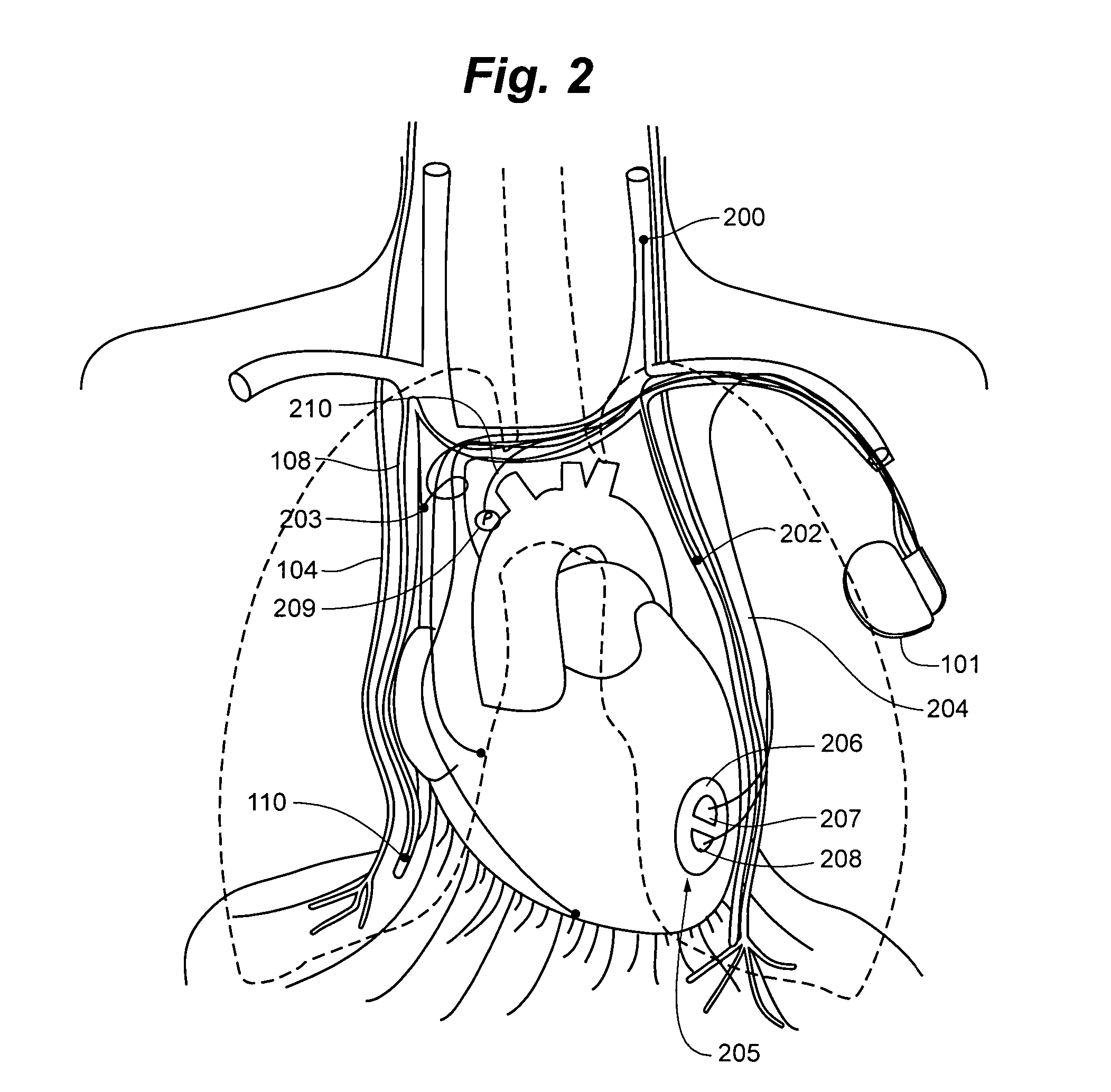 System and method to modulate phrenic nerve to prevent sleep apnea