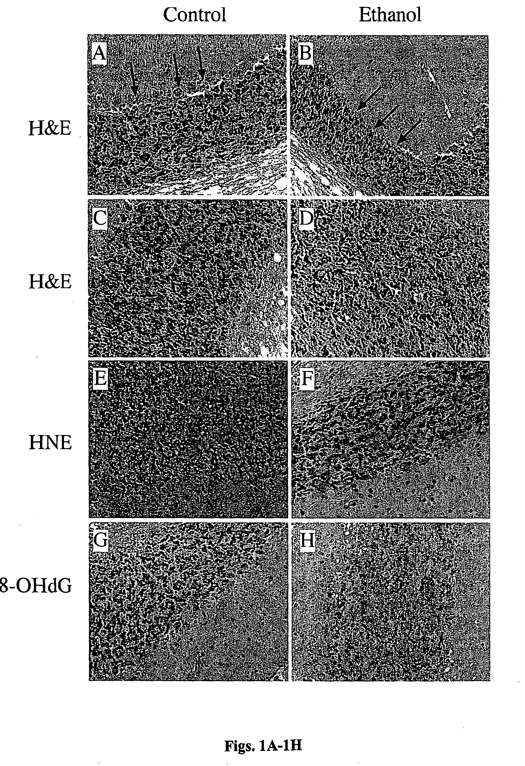 Treatment, prevention, and reversal of alcohol-induced brain disease