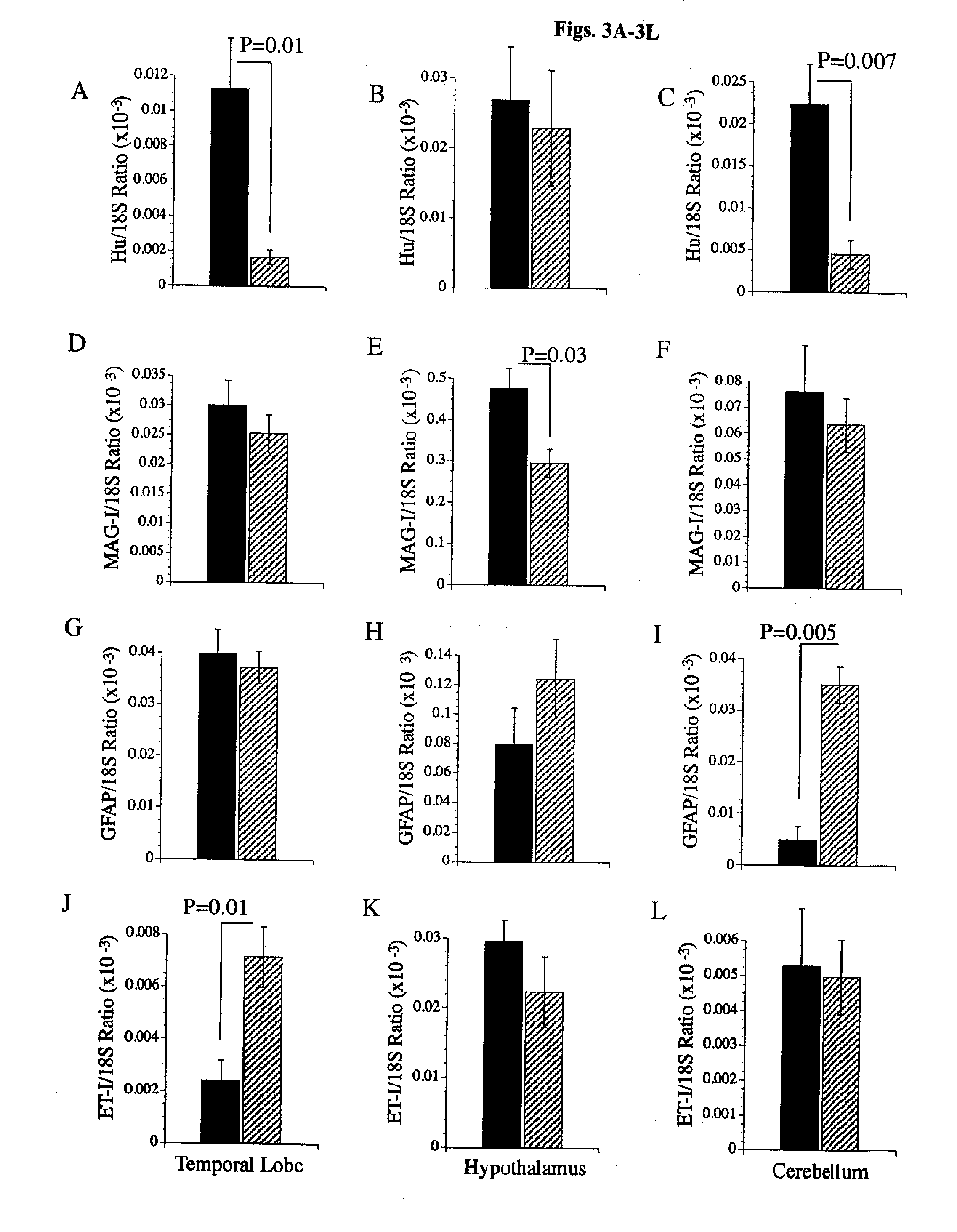 Treatment, prevention, and reversal of alcohol-induced brain disease