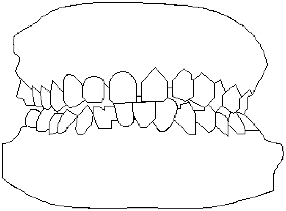 Mandibular condyle motion track measuring method for manufacturing mandibular condyle prosthesis