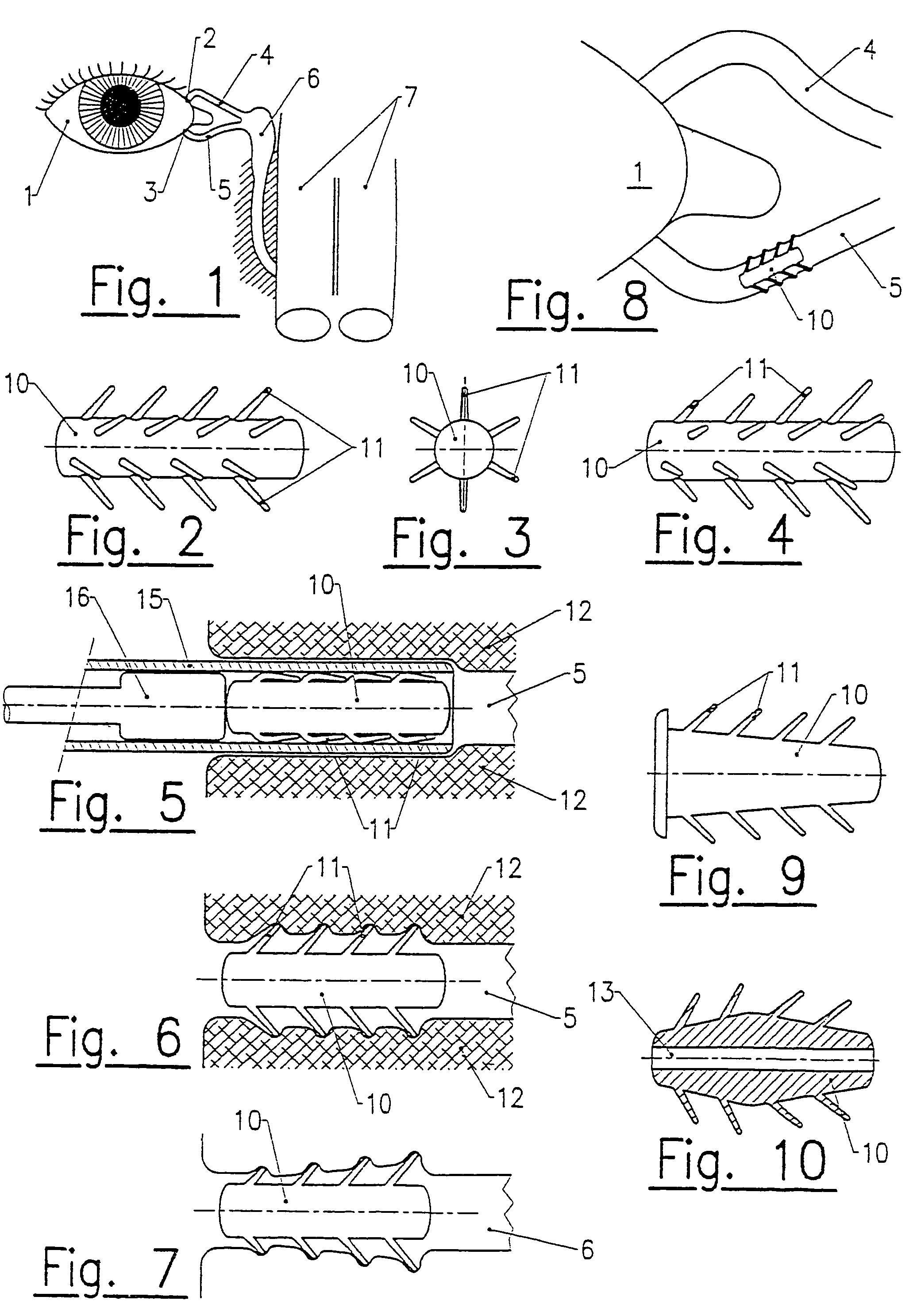 Lachrymal plugs and methods for setting same