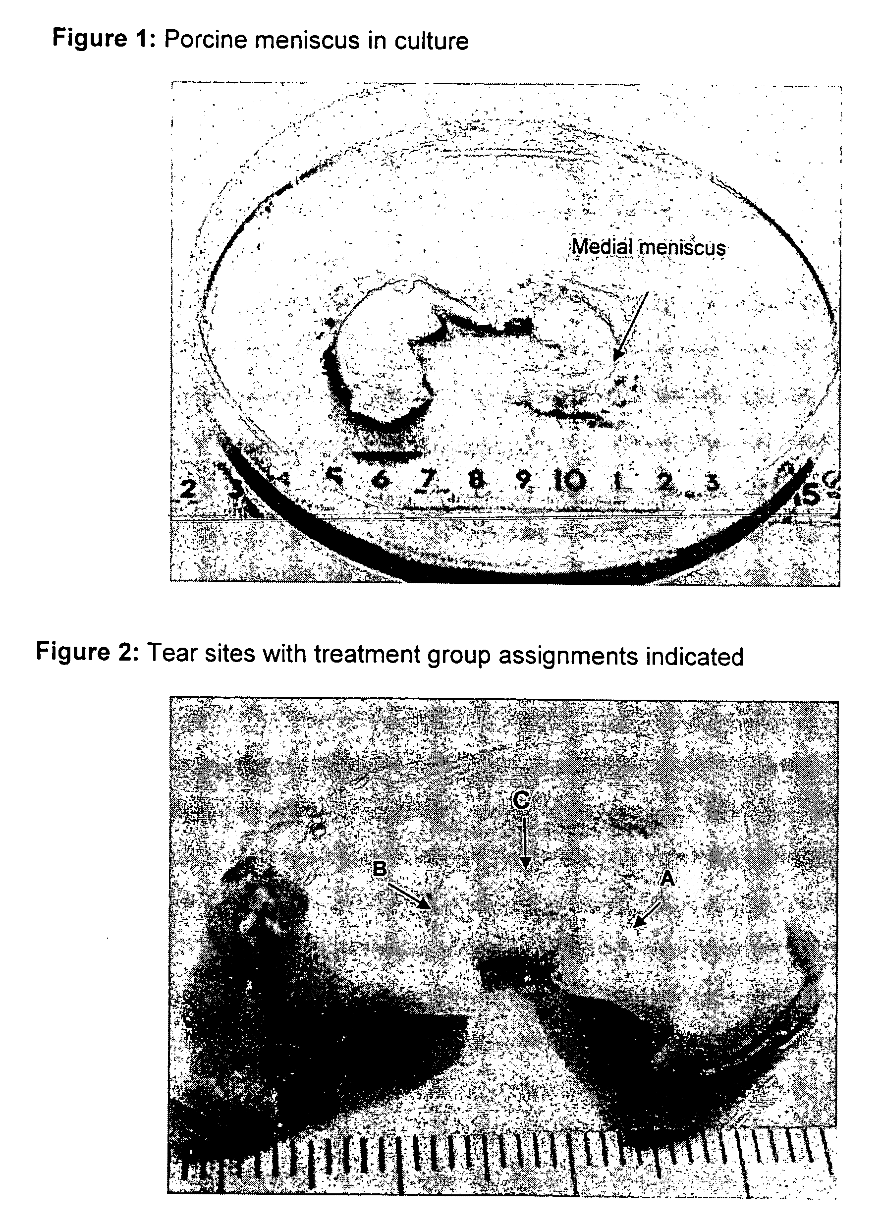 Method for treatment and repair of meniscal injuries