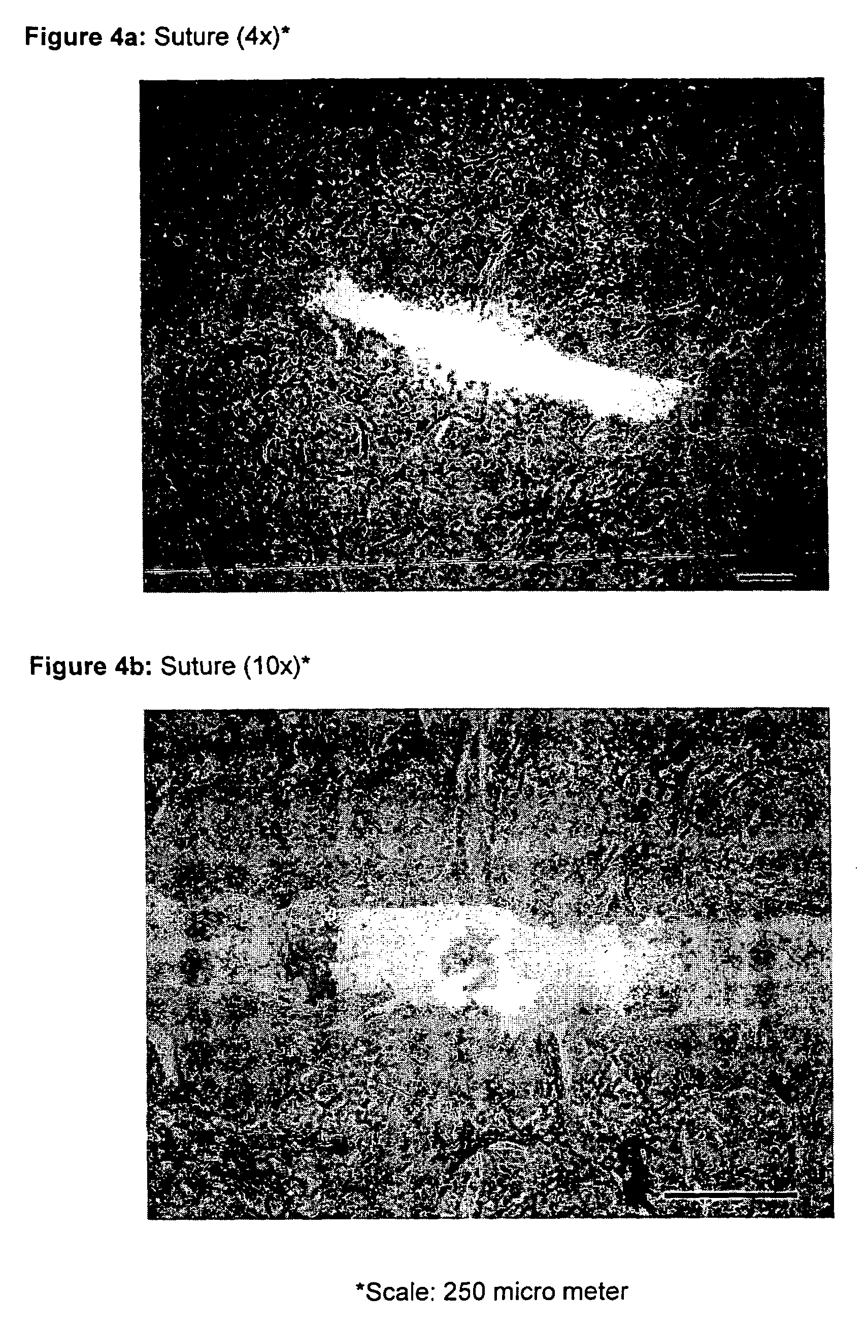 Method for treatment and repair of meniscal injuries