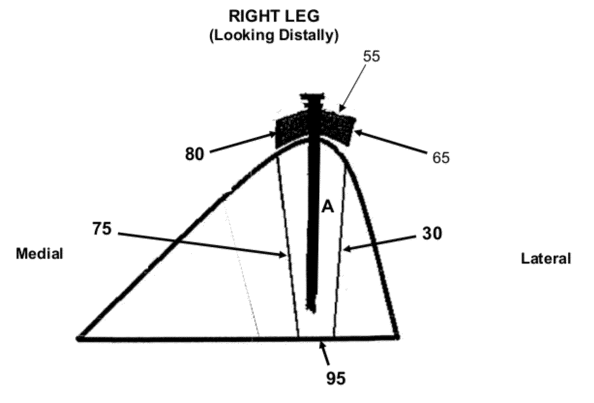 Method and apparatus for performing multidirectional tibial tubercle transfers