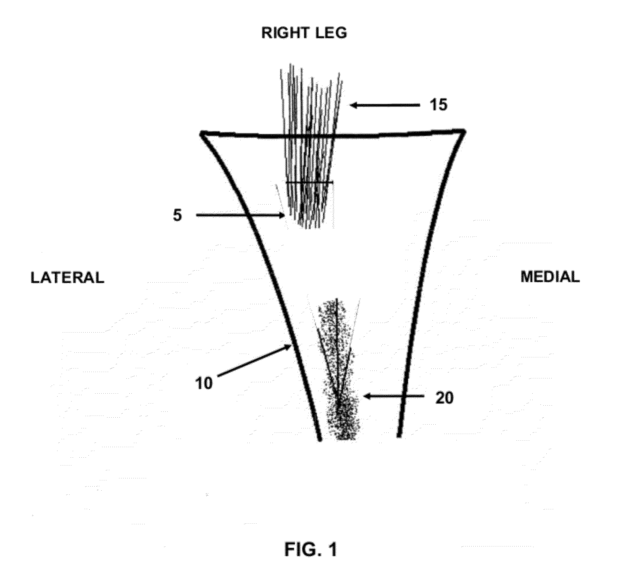 Method and apparatus for performing multidirectional tibial tubercle transfers