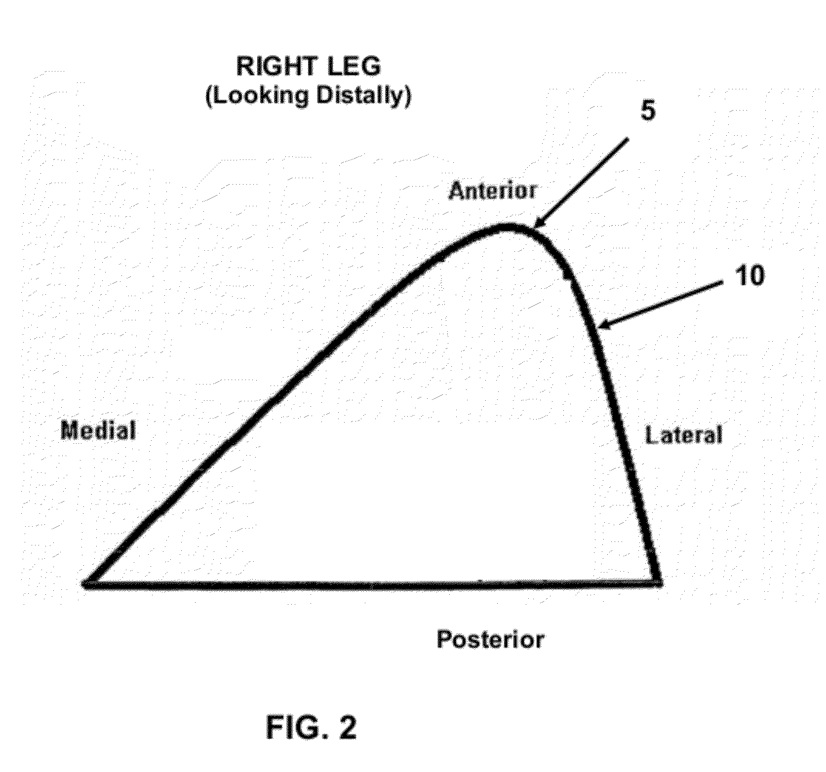 Method and apparatus for performing multidirectional tibial tubercle transfers