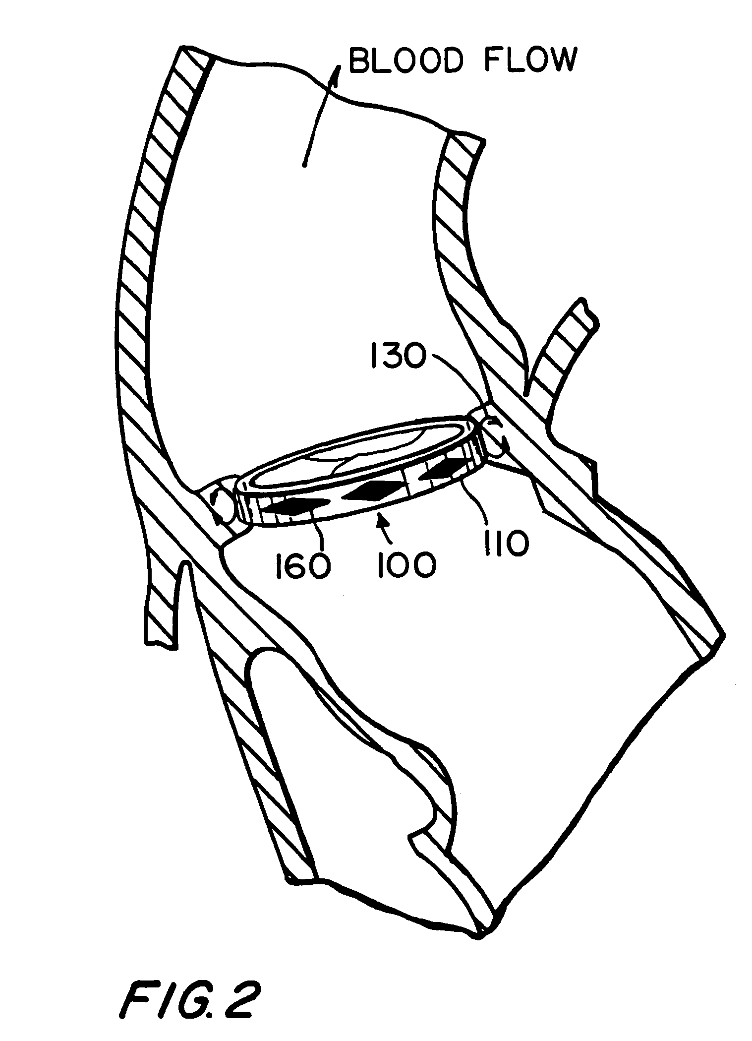 Artificial heart valve attachment apparatus and methods