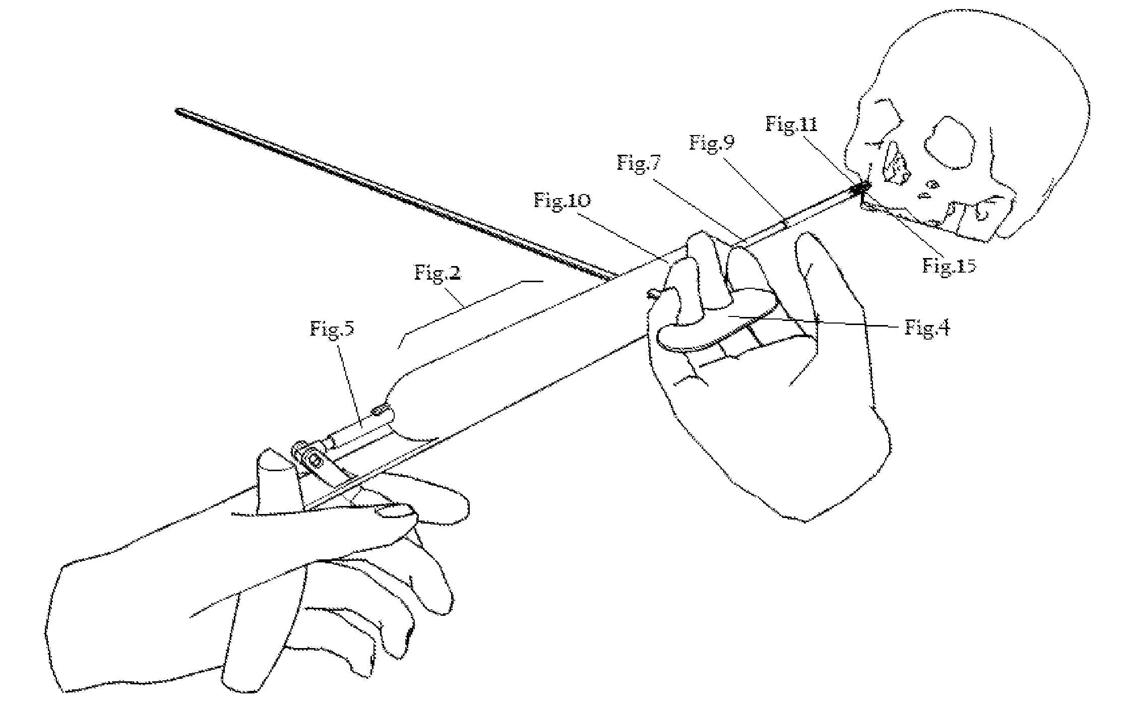 Sealing holes in bony cranial anatomy using custom fabricated inserts