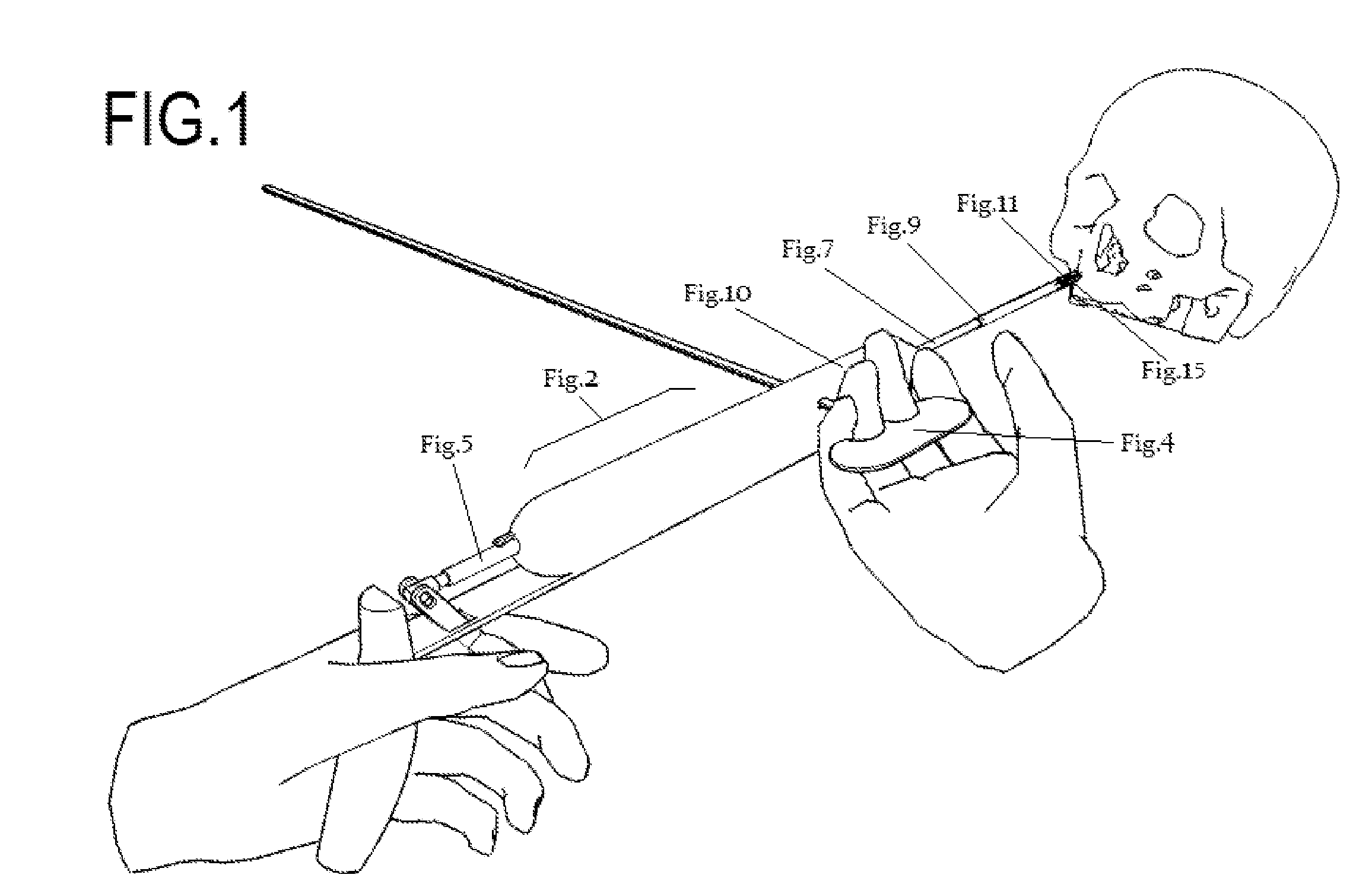 Sealing holes in bony cranial anatomy using custom fabricated inserts