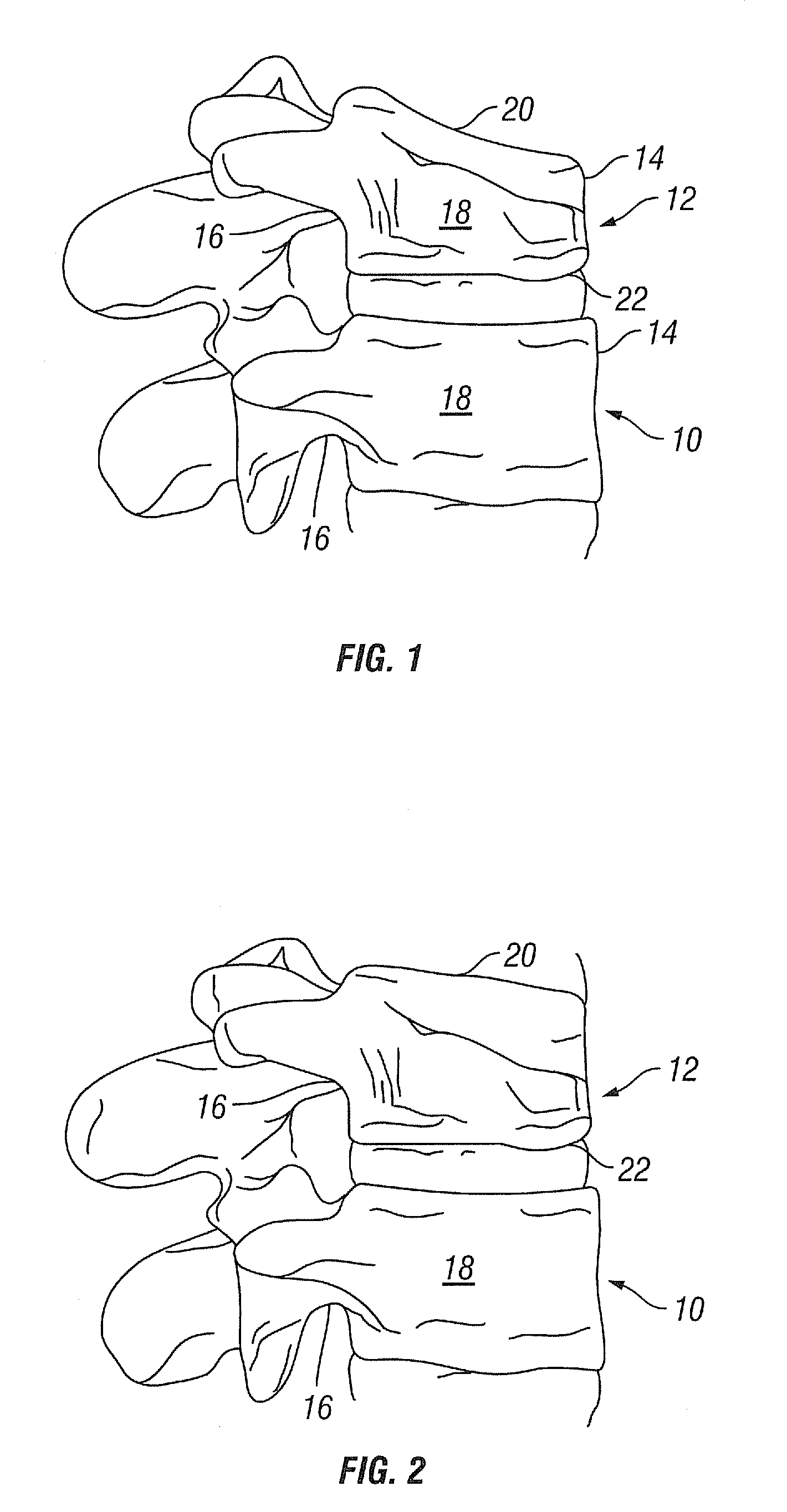 Devices and Methods for Treating Vertebral Fractures