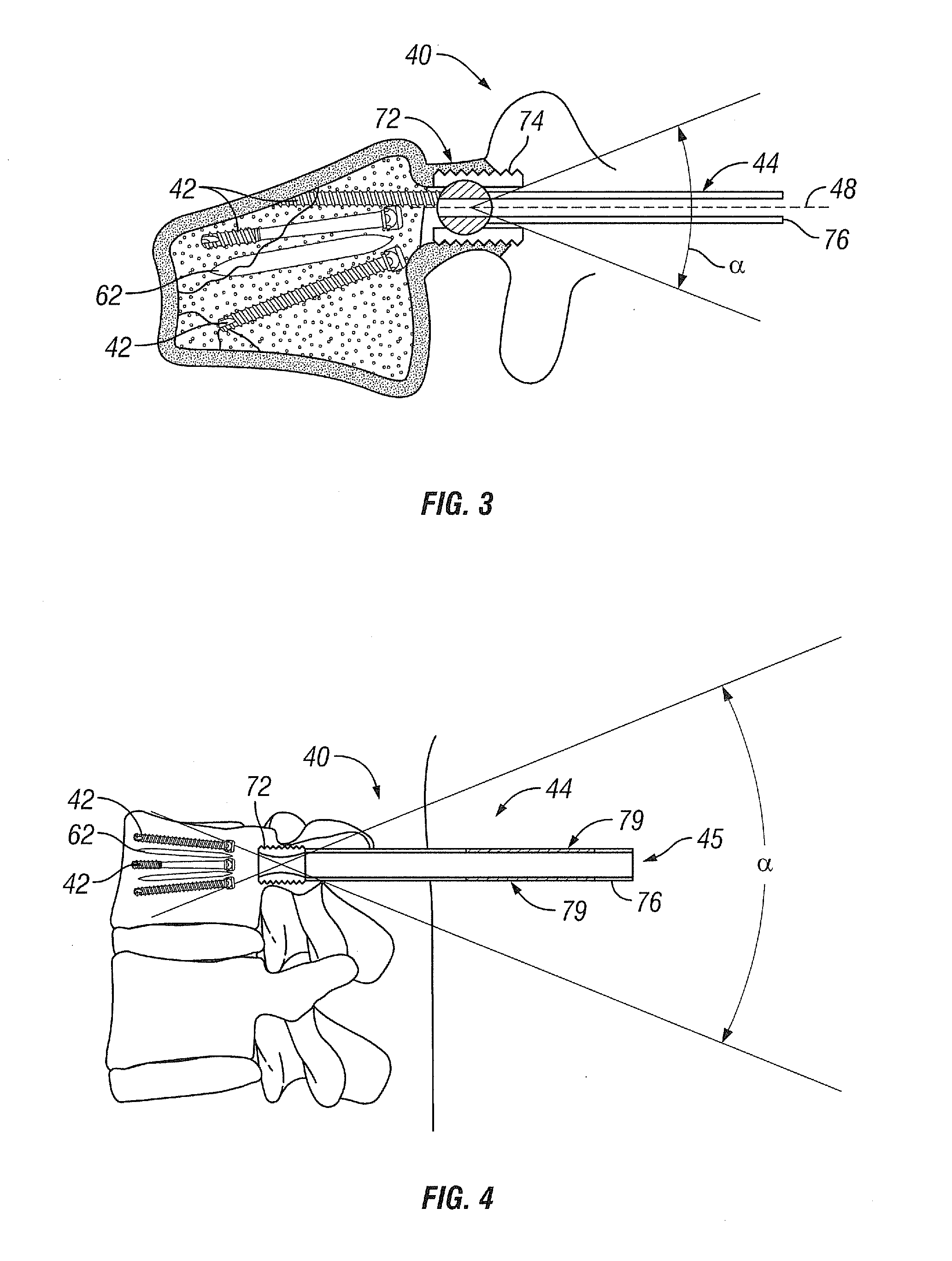 Devices and Methods for Treating Vertebral Fractures