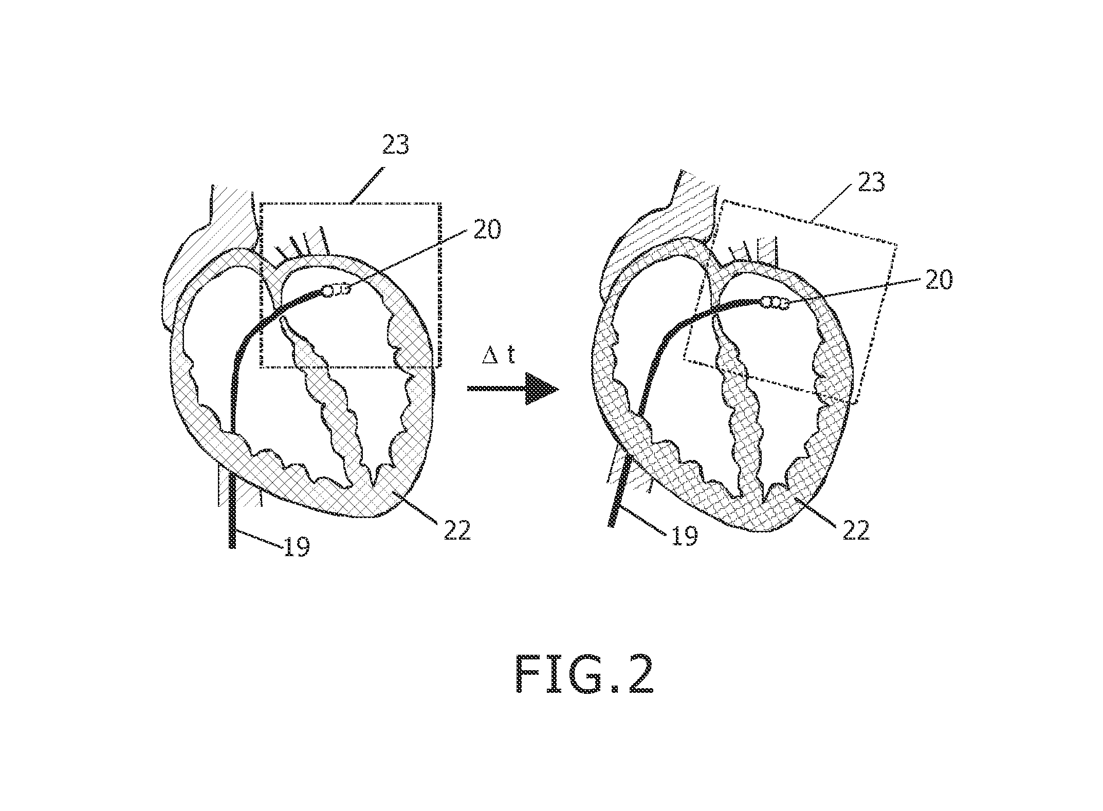 Interventional MR imaging with motion compensation