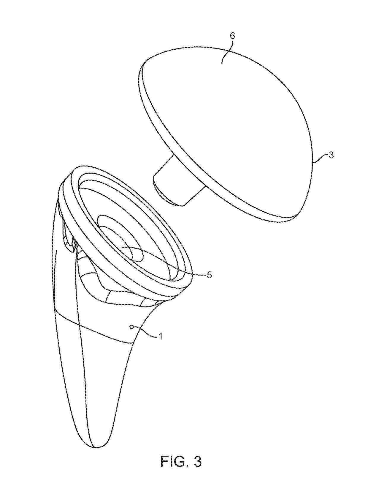 Shoulder arthroplasty implant system