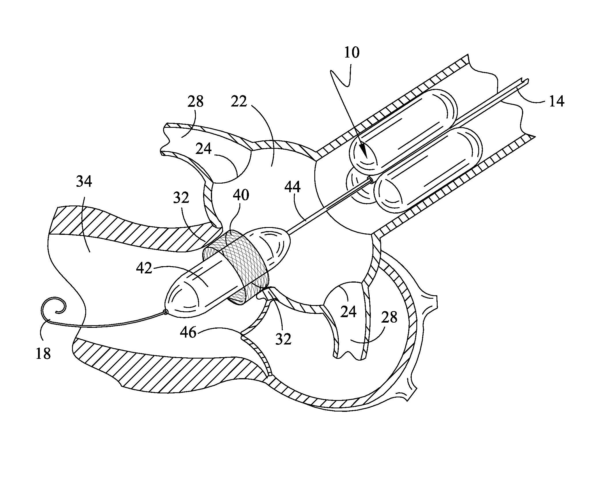 Method and apparatus for percutaneous aortic valve replacement