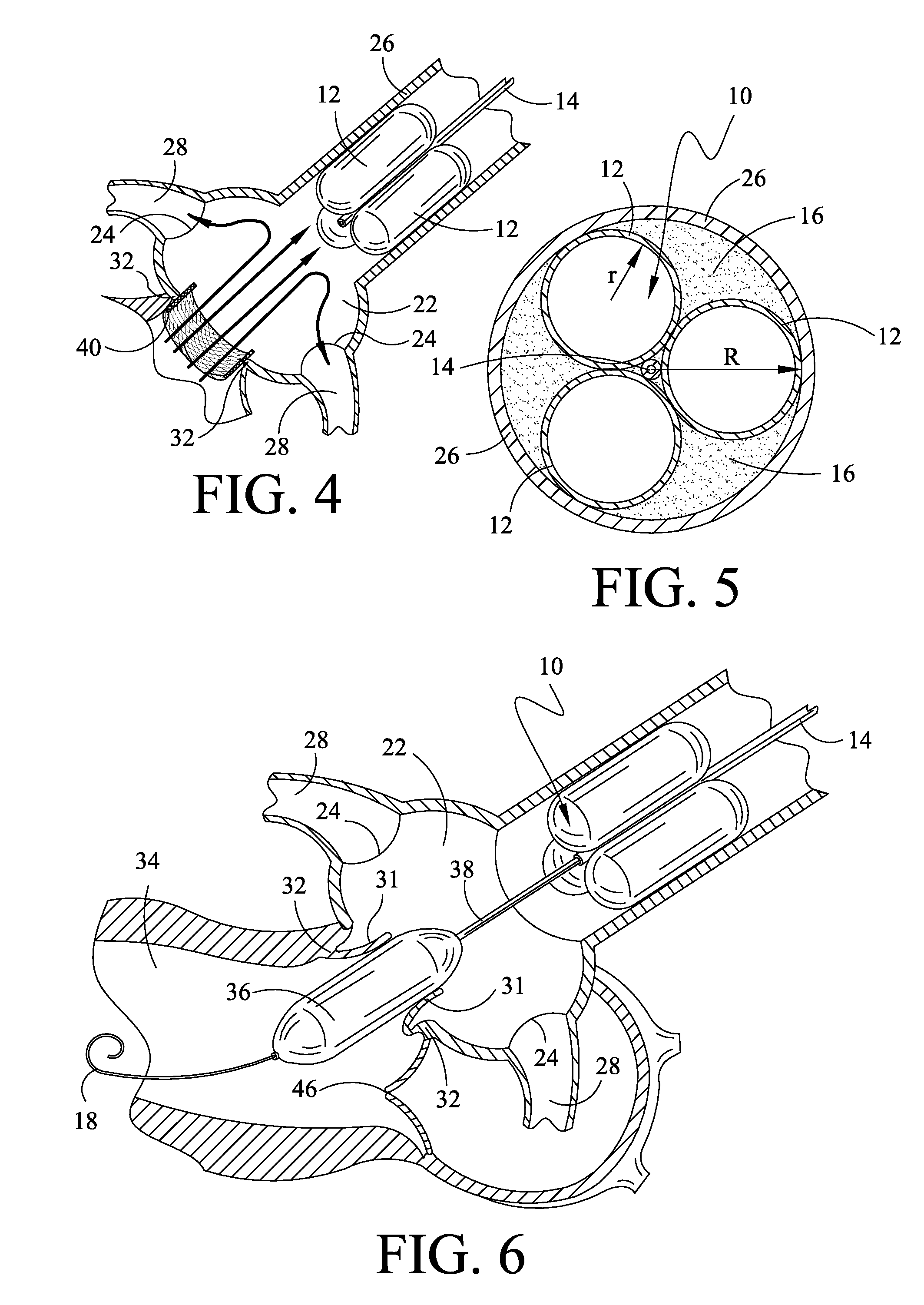 Method and apparatus for percutaneous aortic valve replacement