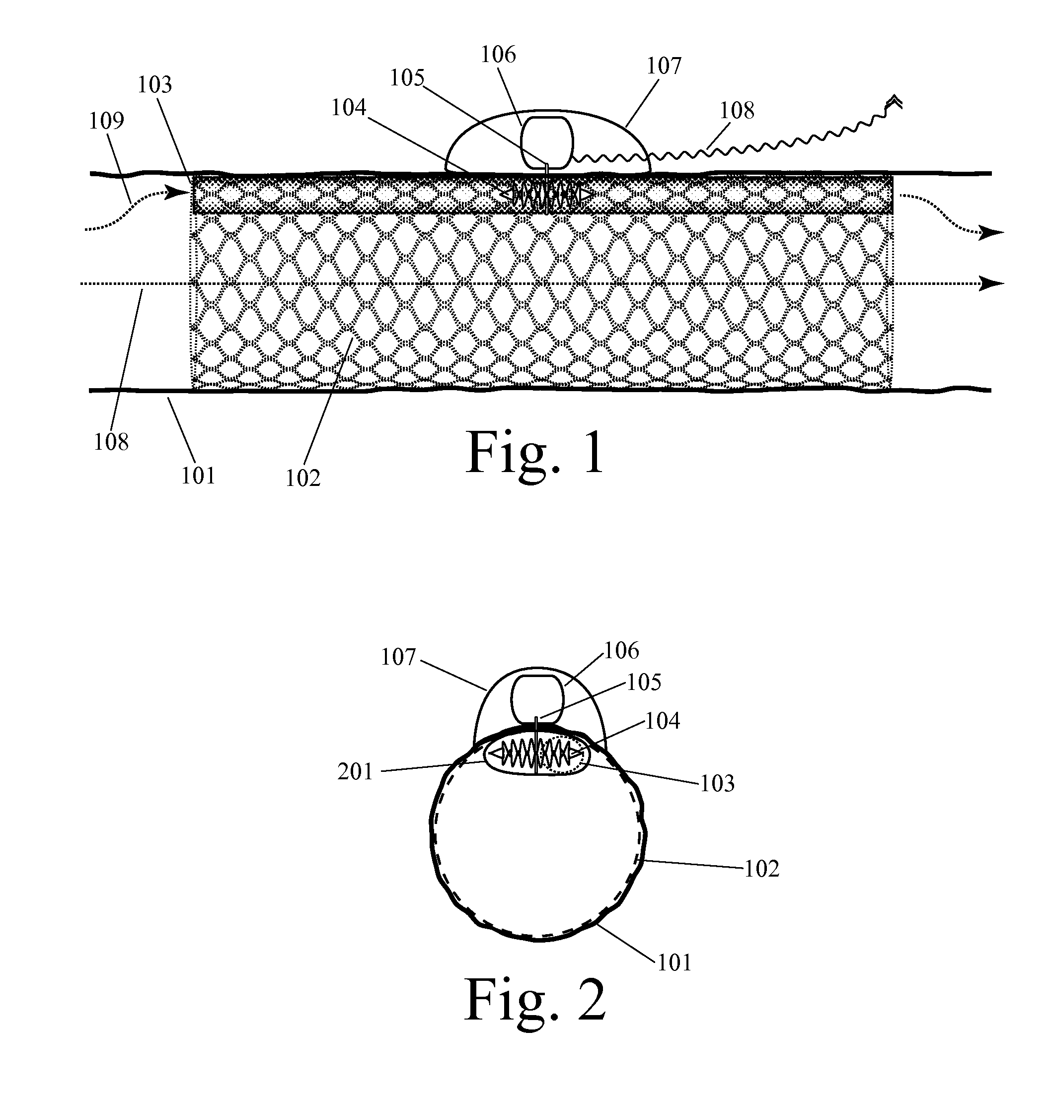 Implanted Extracardiac Device for Circulatory Assistance