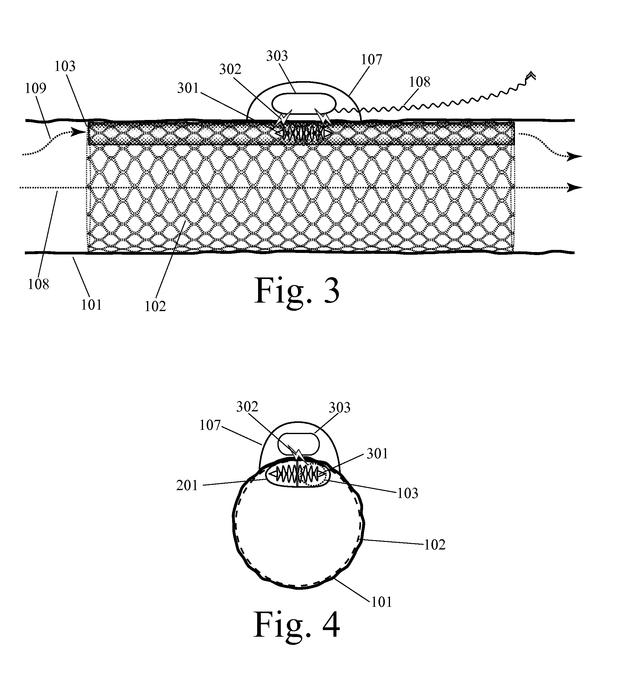 Implanted Extracardiac Device for Circulatory Assistance