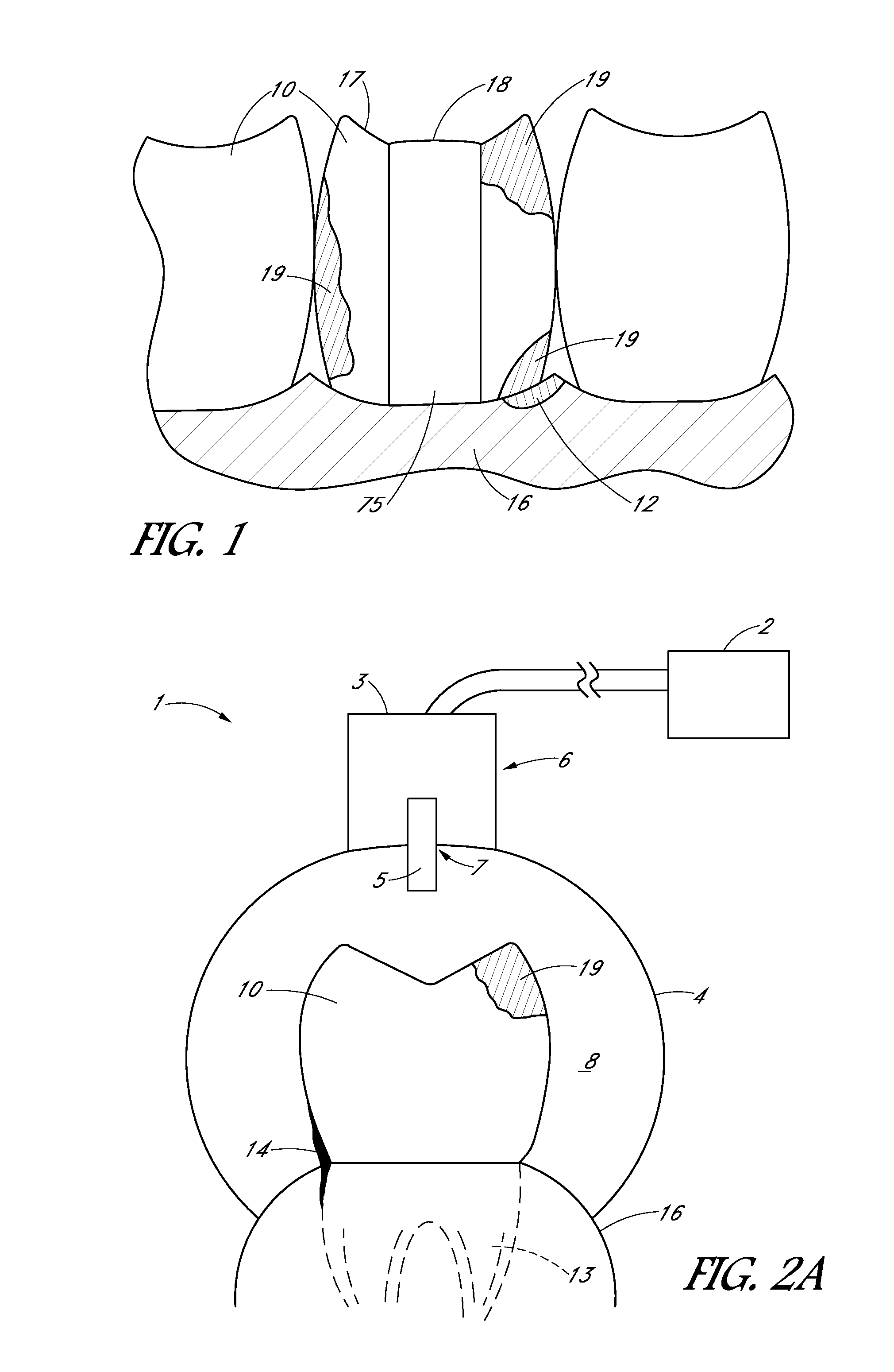 Apparatus and methods for treating teeth