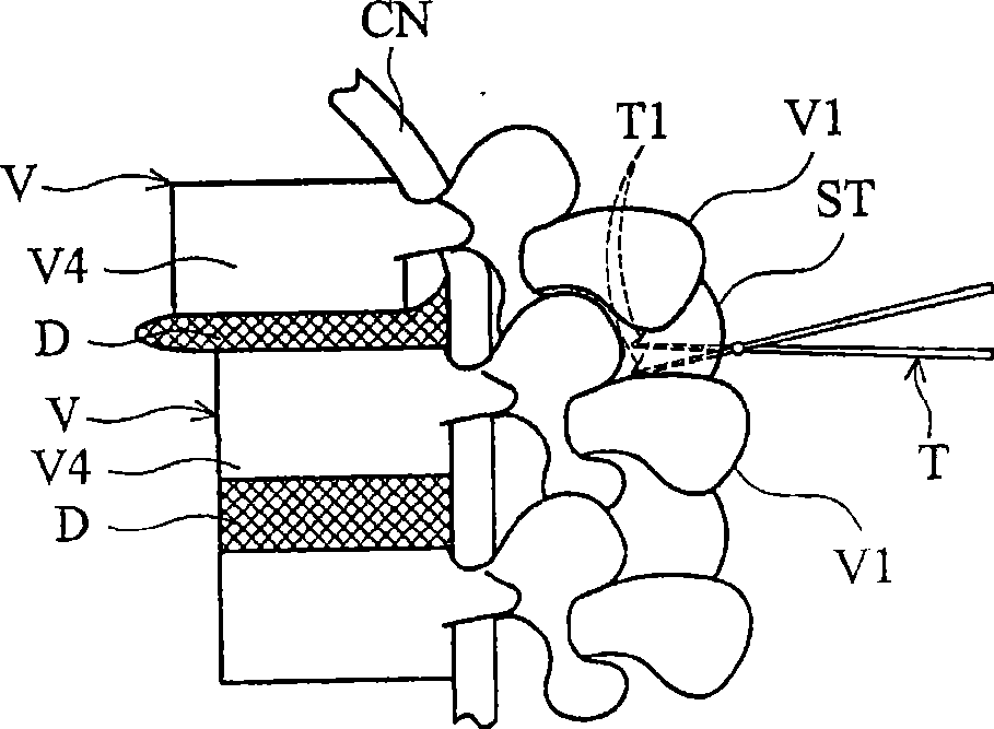 Dynamic stabilizing device for vertebra