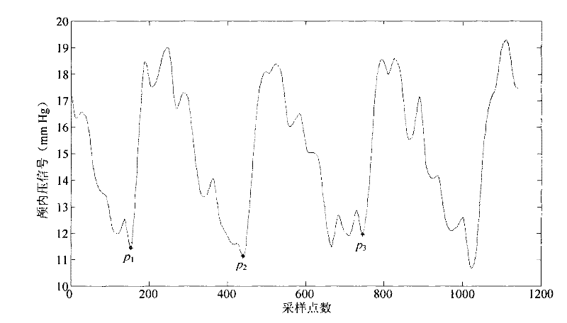 Beat-to-beat division method of intracranial pressure signal based on waveform character matching