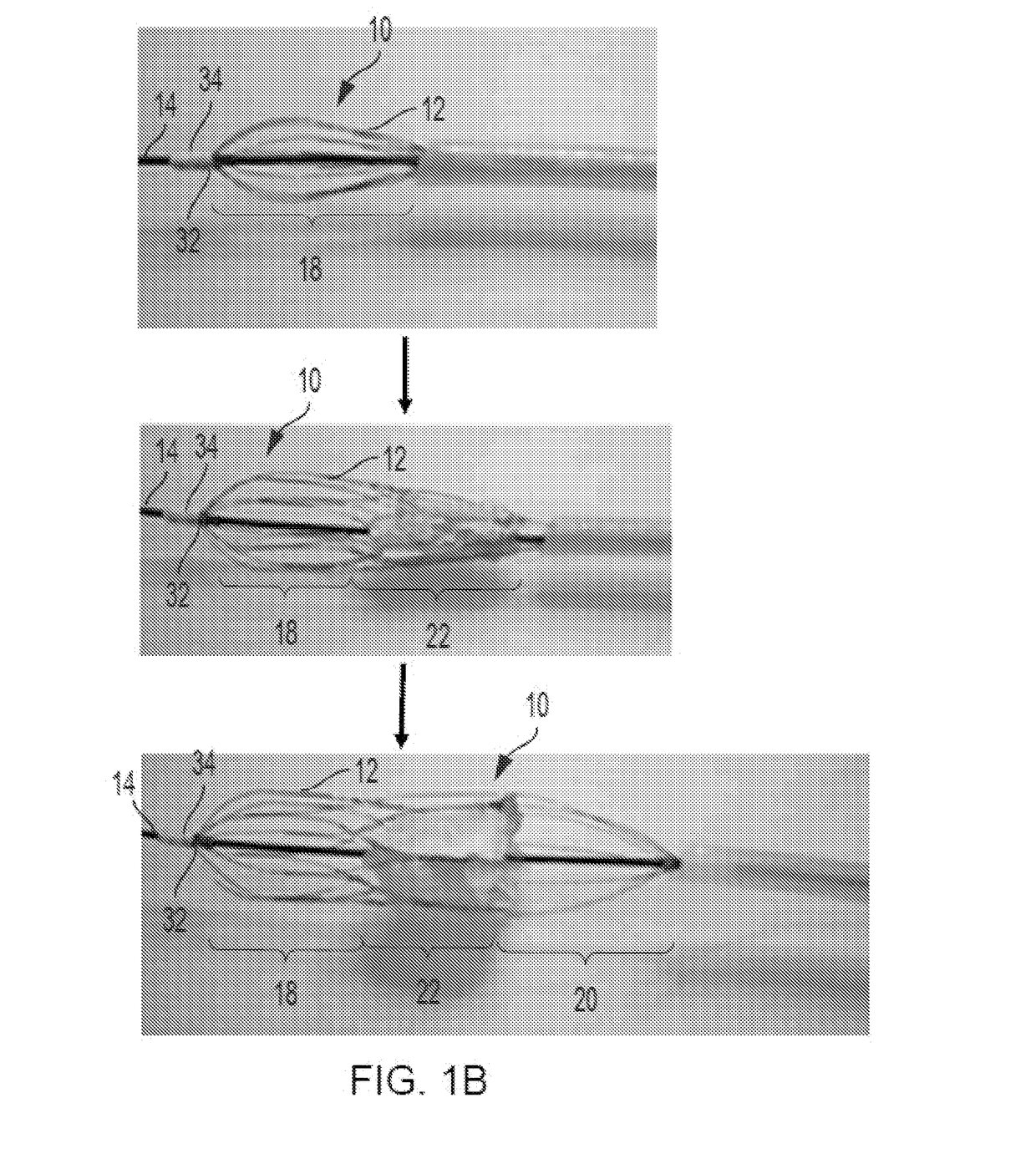 Retrievable Self-expanding Non-thrombogenic Low-profile Percutaneous Atrioventricular Valve Prosthesis