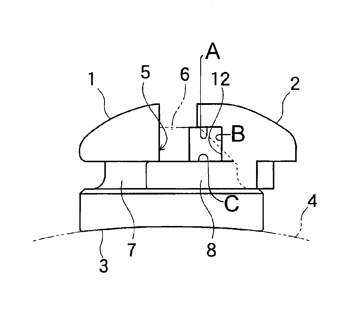 Orthodontic bracket