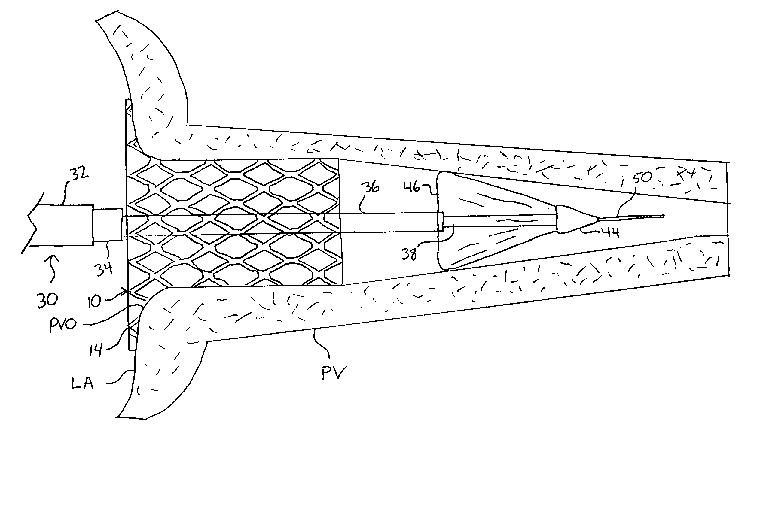 Device and method for electrical isolation of the pulmonary veins