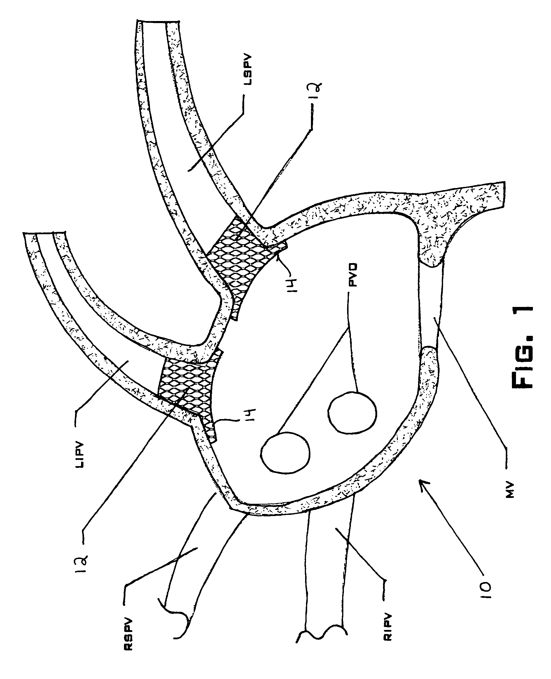 Device and method for electrical isolation of the pulmonary veins