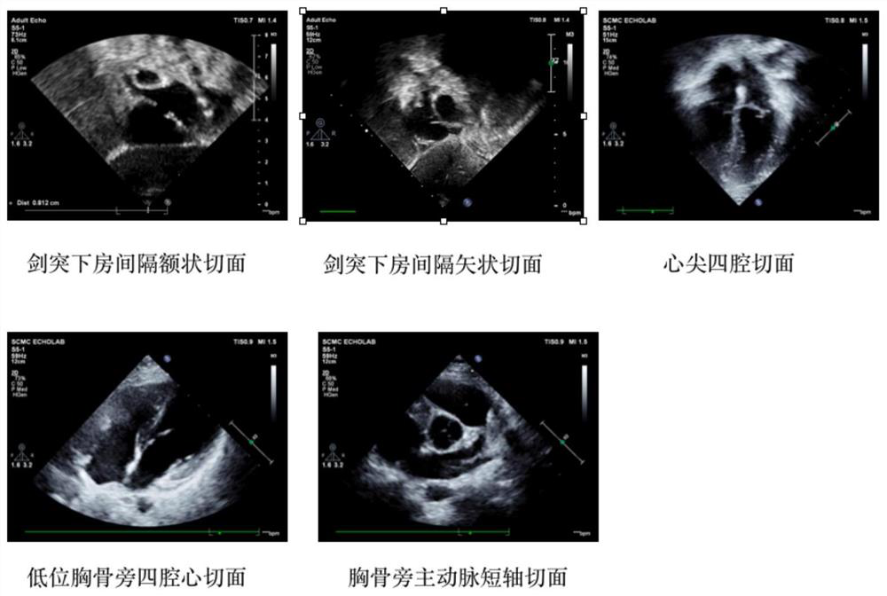 Deep learning atrial septal defect detection method and device