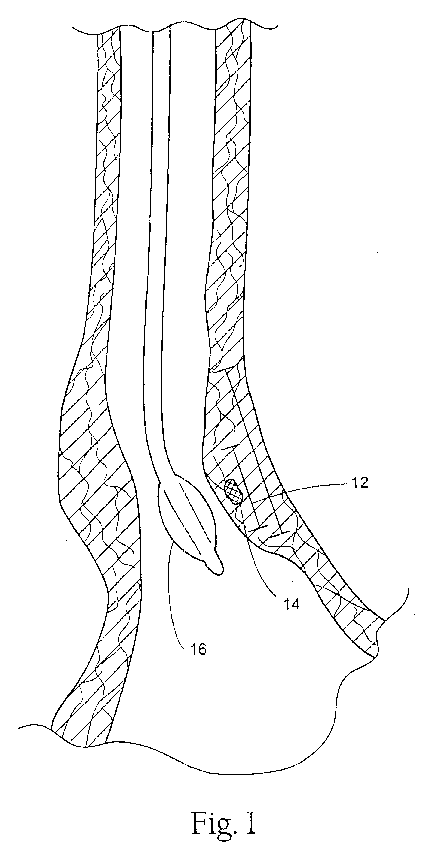 GERD treatment apparatus and method