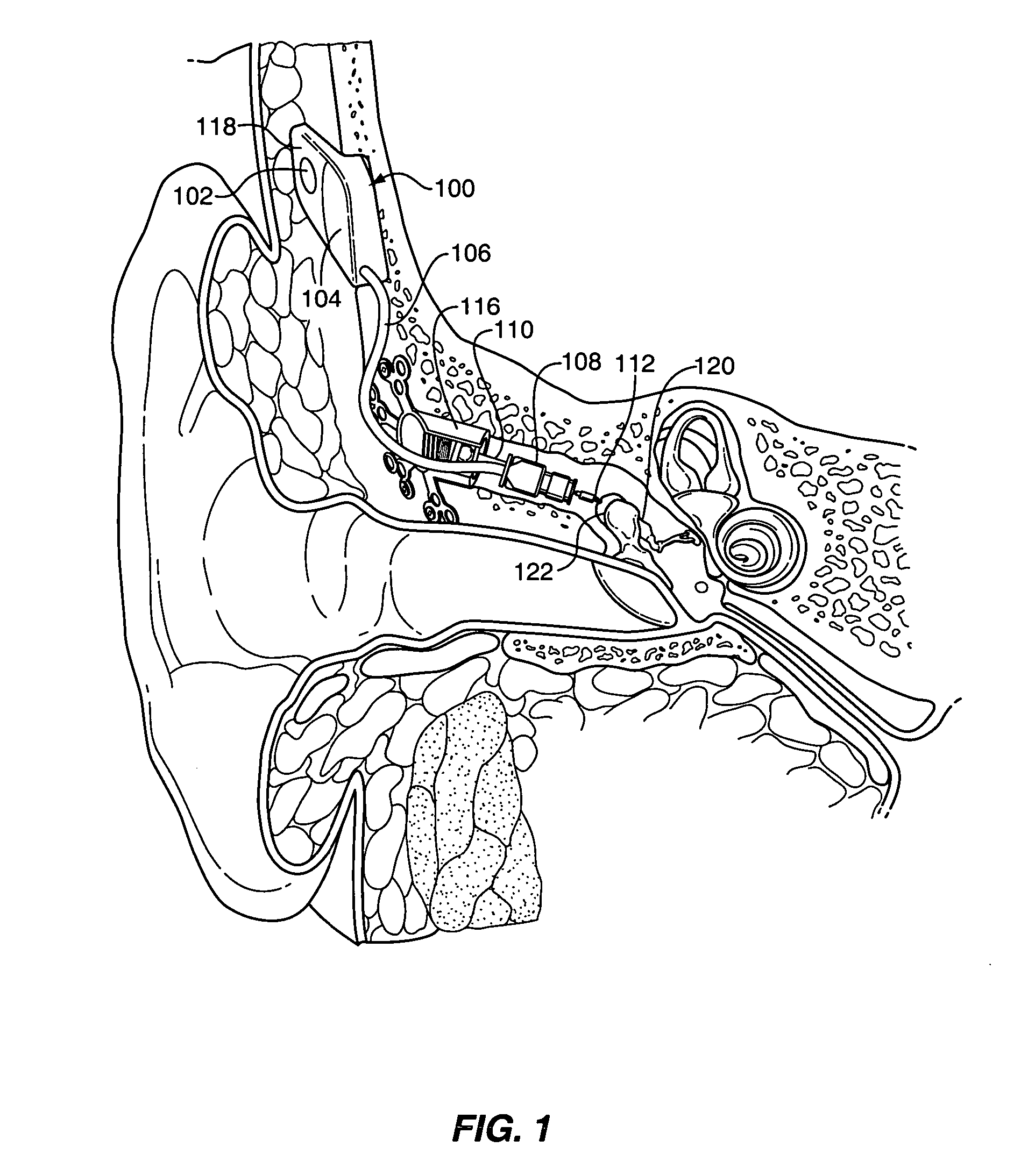 Apparatus for connection of implantable devices to the auditory system