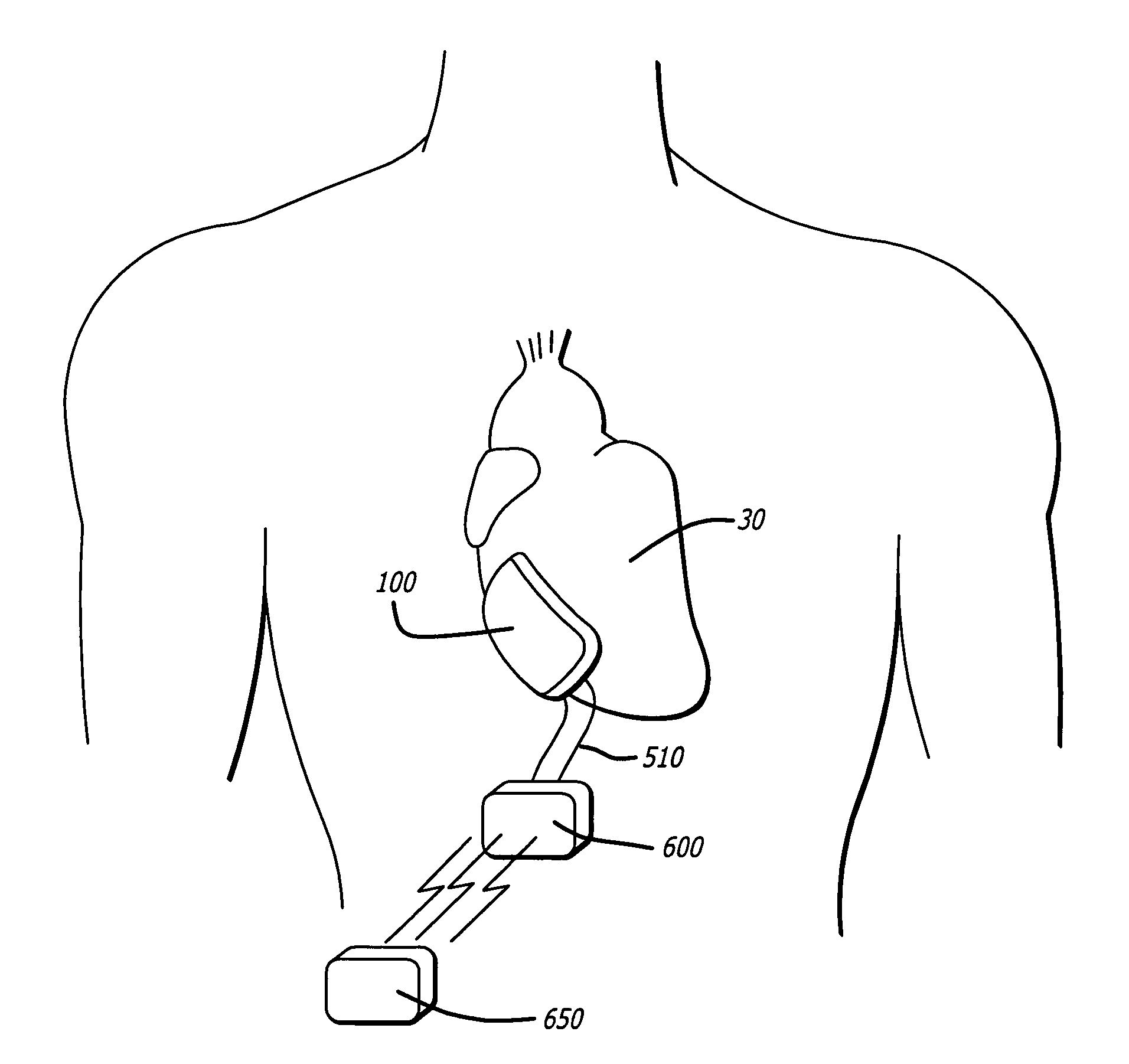 Inflatable cardiac device for treating and preventing ventricular remodeling