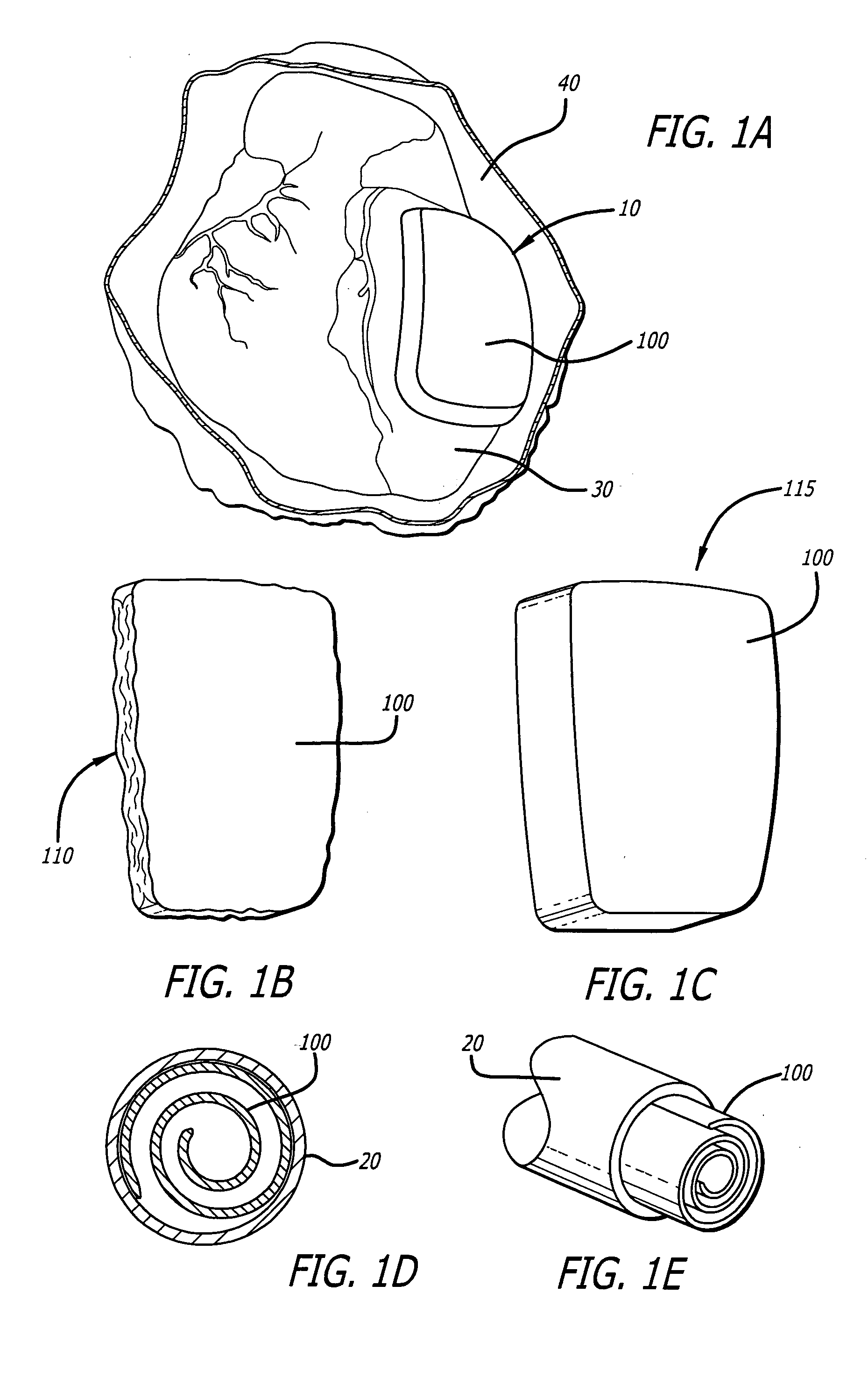 Inflatable cardiac device for treating and preventing ventricular remodeling