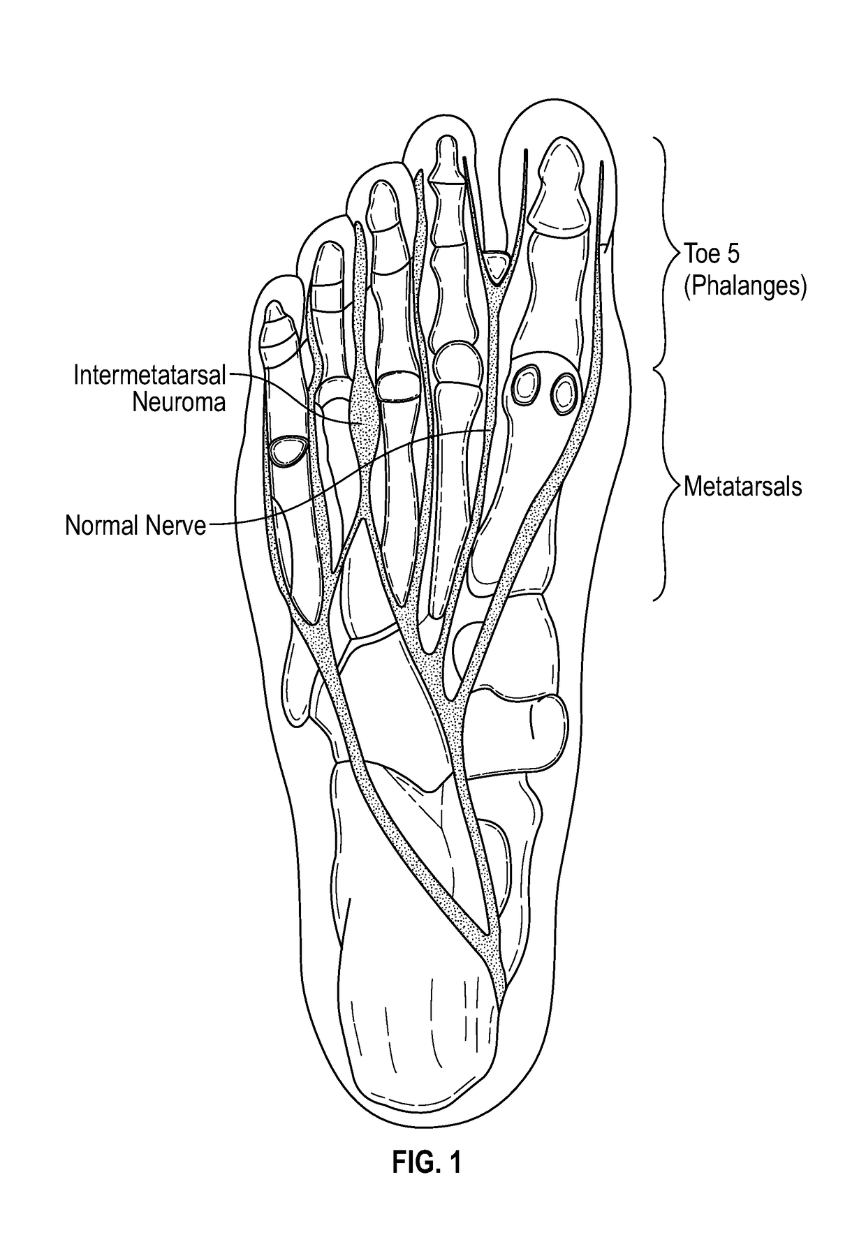 Non-surgical laser treatment for a fibrous mass