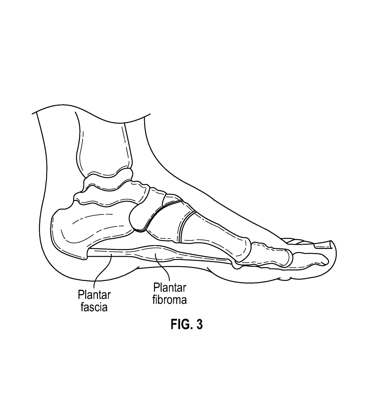 Non-surgical laser treatment for a fibrous mass