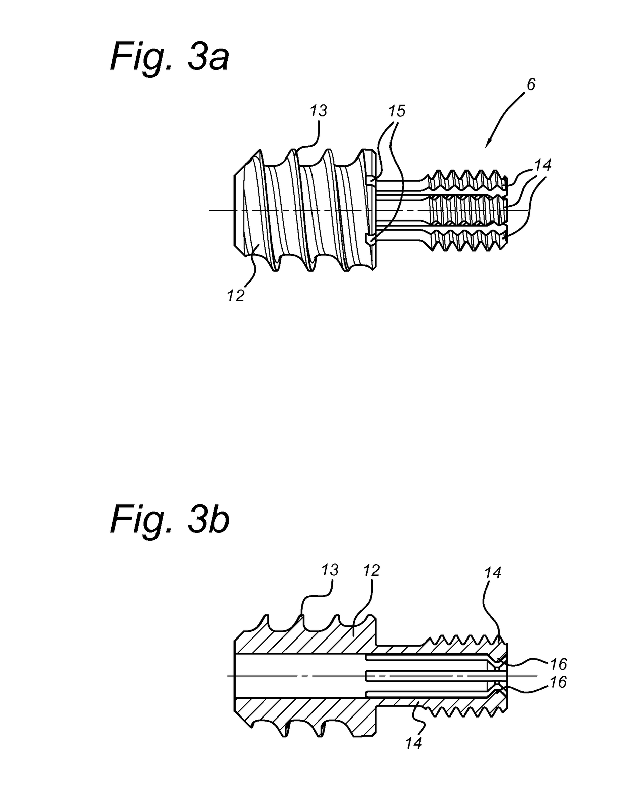 Intramedullary device for mid-shaft clavicle fractures