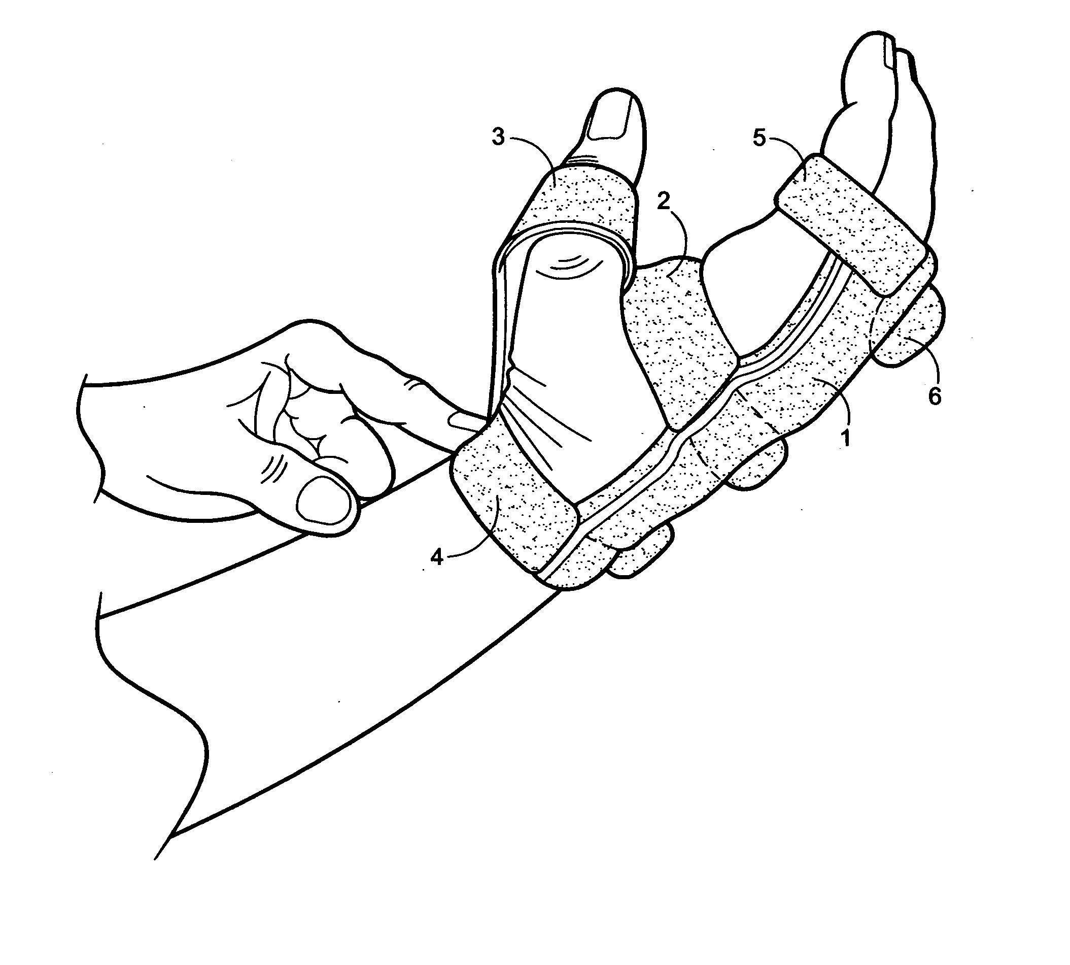 Low-profile, radial nerve splint with interchangeable resilient digit extensor elements