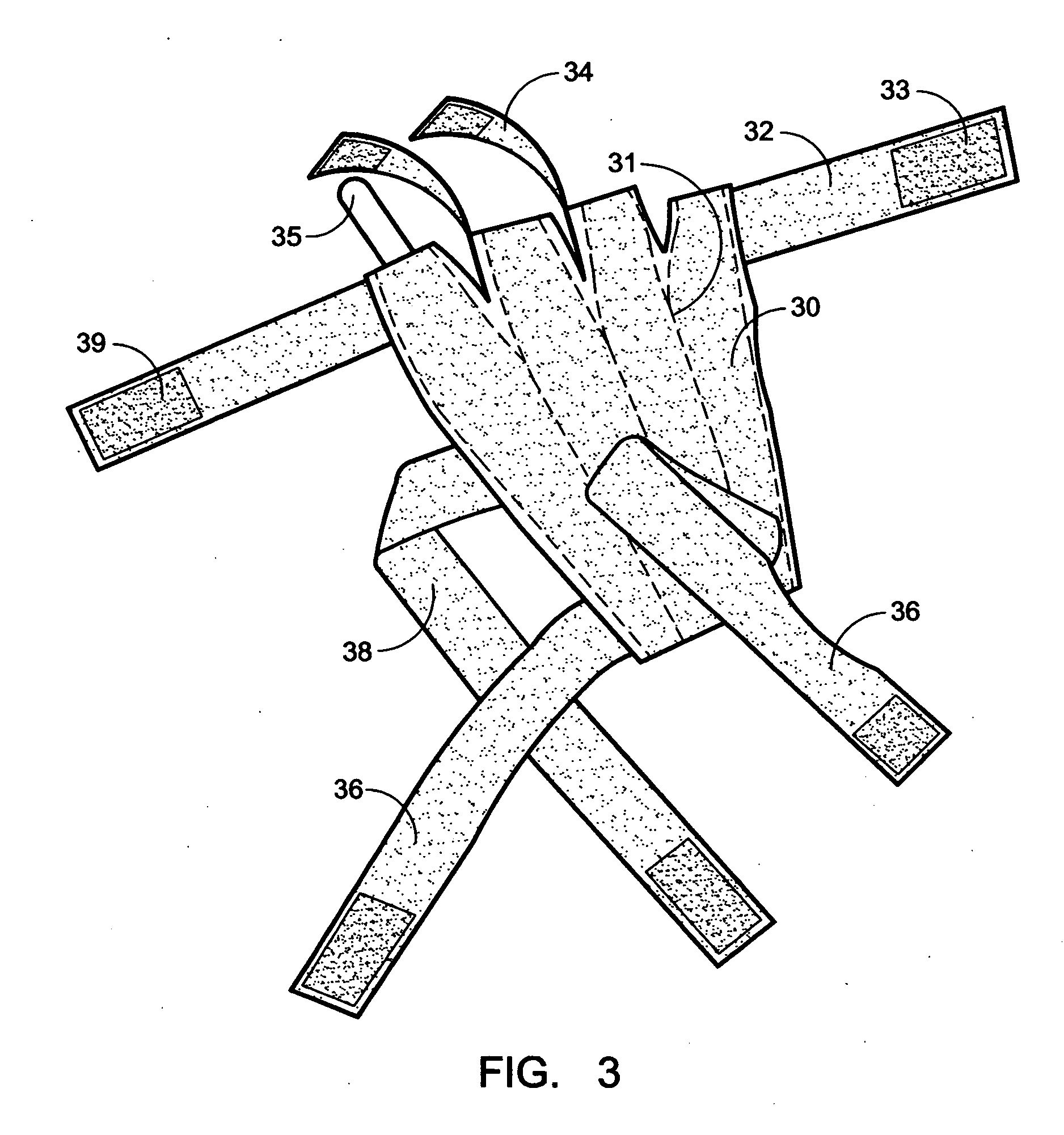 Low-profile, radial nerve splint with interchangeable resilient digit extensor elements