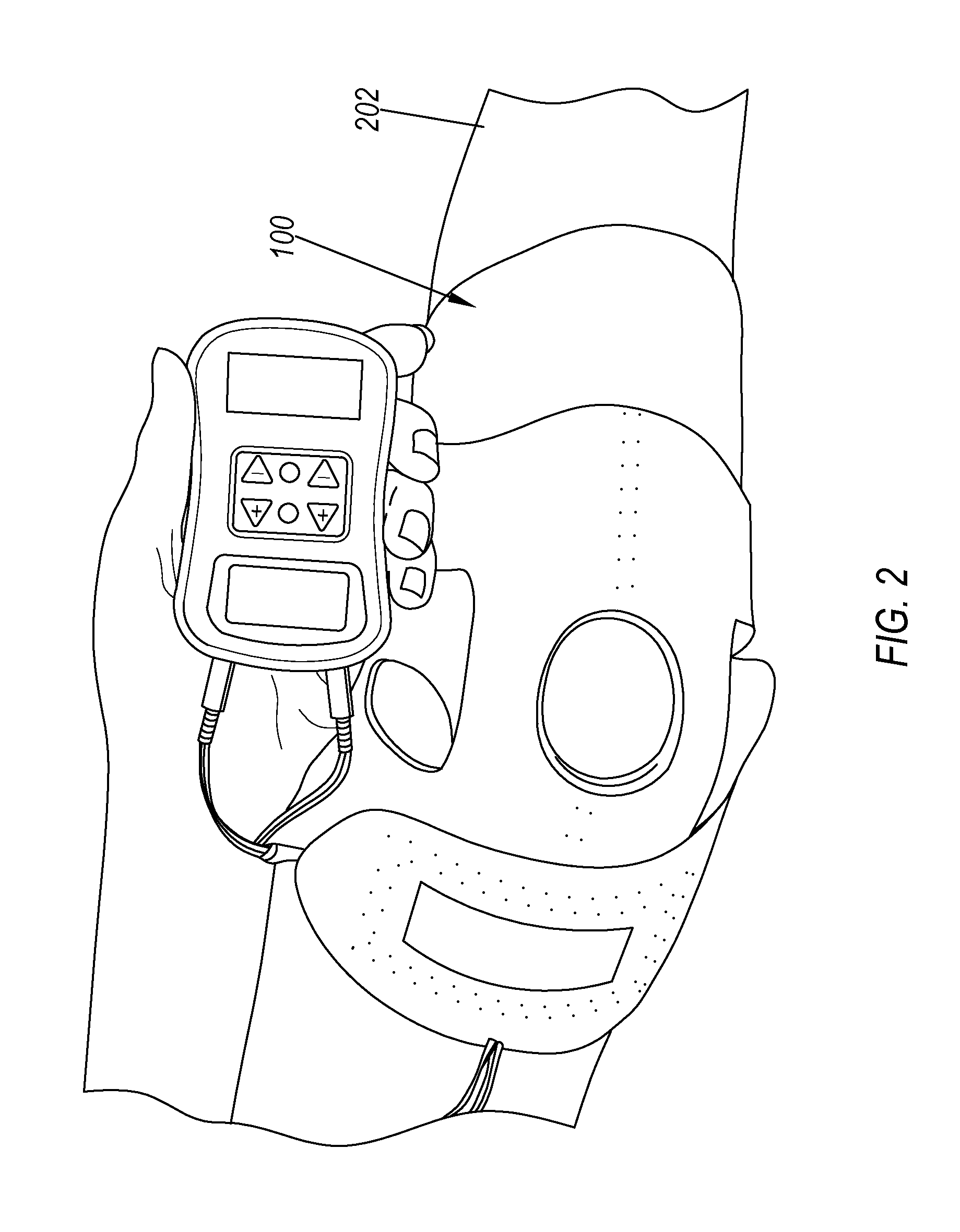 Transcutaneous electrical nerve stimulation of the knee