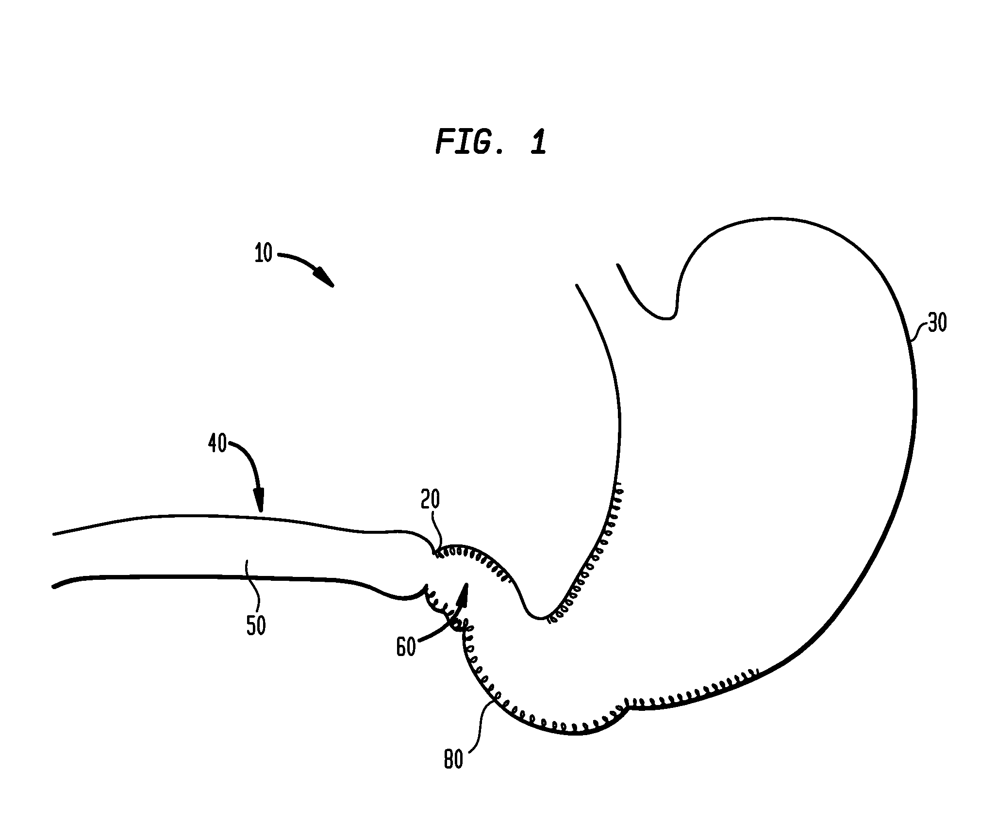 Systems and methods for treating obesity and type 2 diabetes