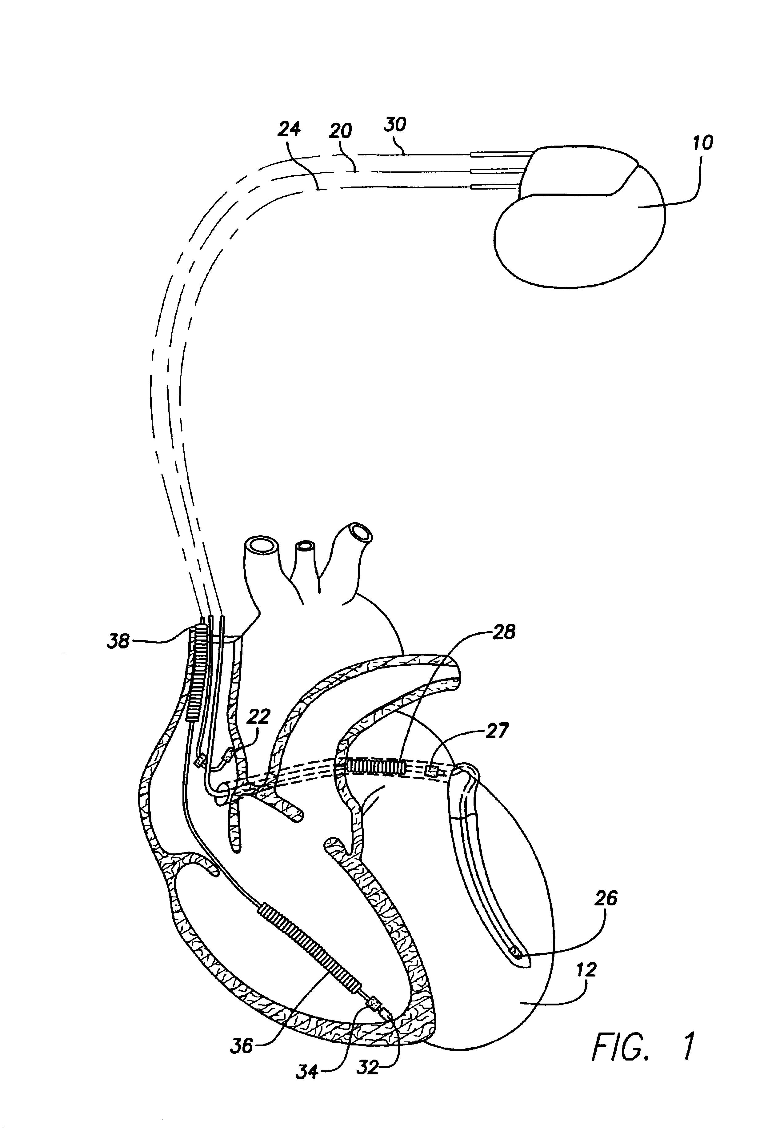 System and method for tracking progression of left ventricular dysfunction using implantable cardiac stimulation device