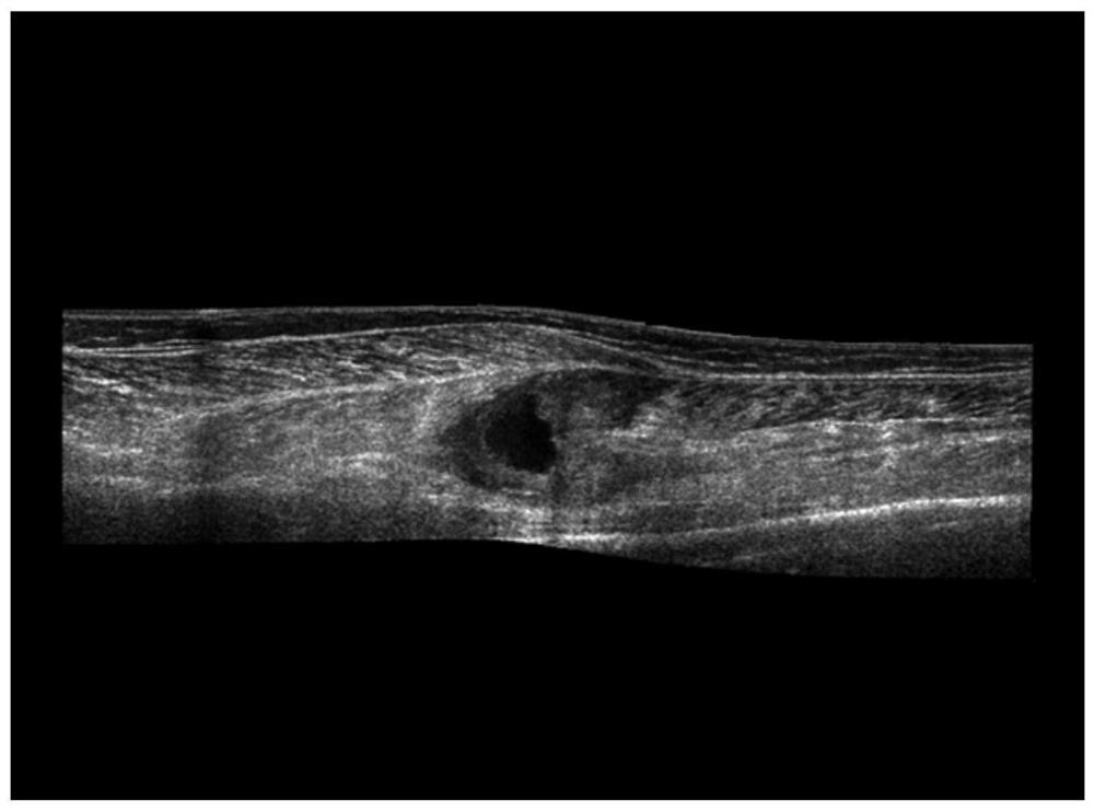 Hybrid high-order variation ultrasonic image denoising method based on Weibull distribution