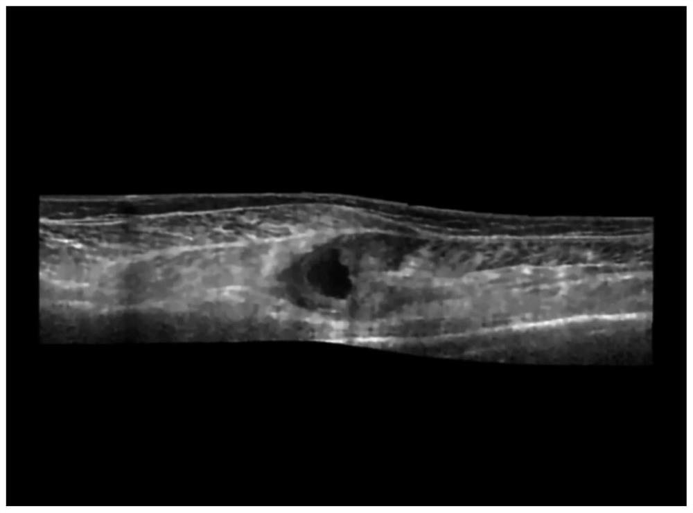 Hybrid high-order variation ultrasonic image denoising method based on Weibull distribution