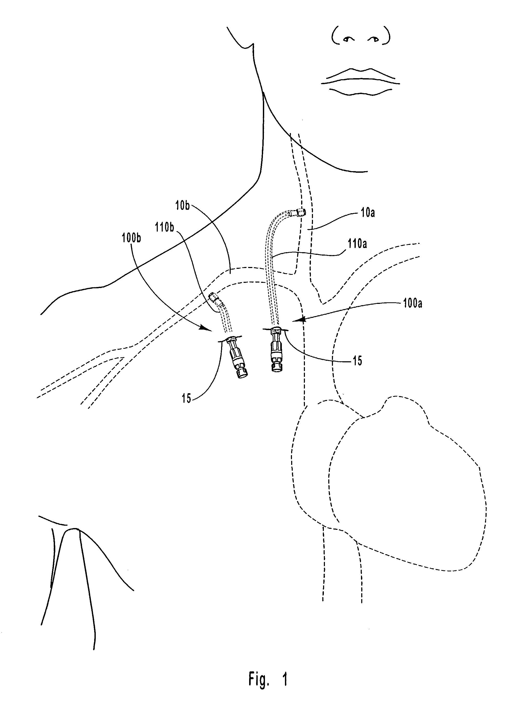 Apparatus and methods for occluding an access tube anastomosed to sidewall of an anatomical vessel