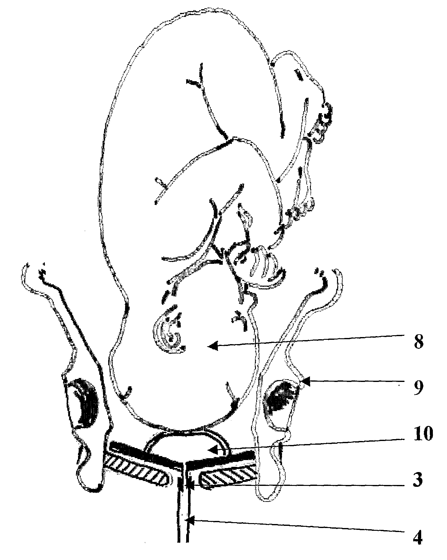 Device to Assist in Cesarean Section